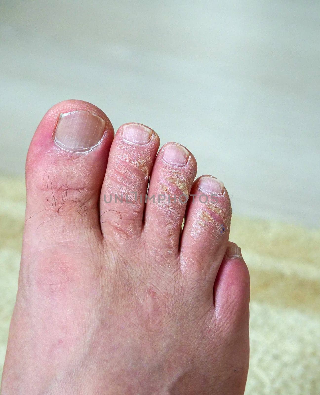 neglected toes, fungus and calluses on the fingers, close-up calloused toes,