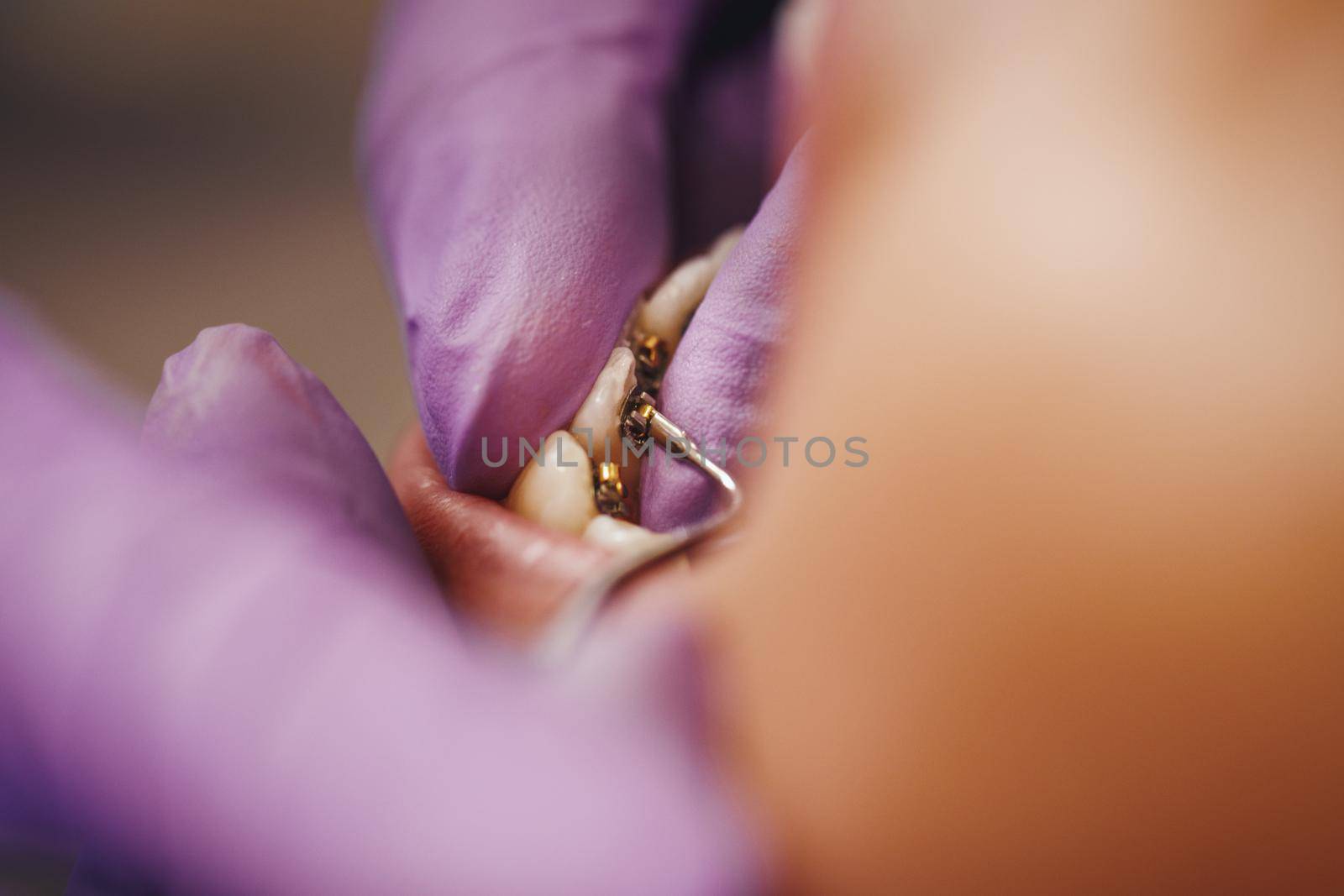 Cropped shot of a beautiful young woman is at the dentist. She sits in the dentist's chair and the dentist sets braces on her teeth putting aesthetic self-aligning lingual locks.