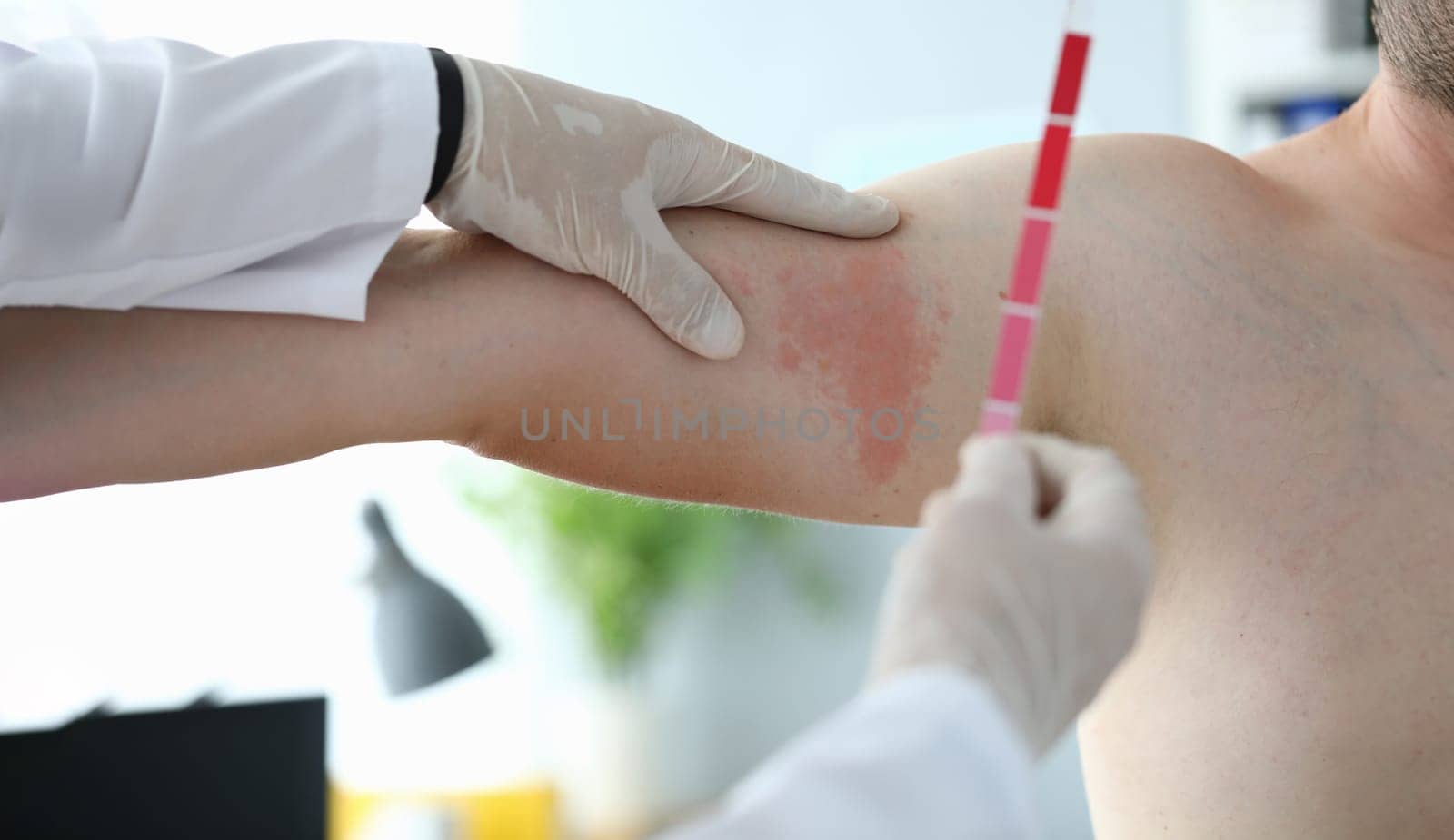 Close-up of medical worker hand holding stick with different types of red colour to define patients spot on arm. Modern medicine, healthcare and dermatology concept