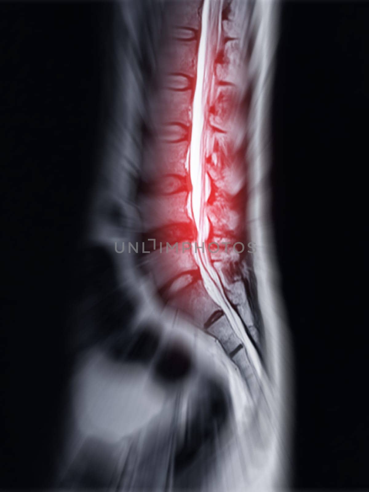MRI L-S spine or lumbar spine Sagittall T2W view  for diagnosis spinal cord compression. by samunella