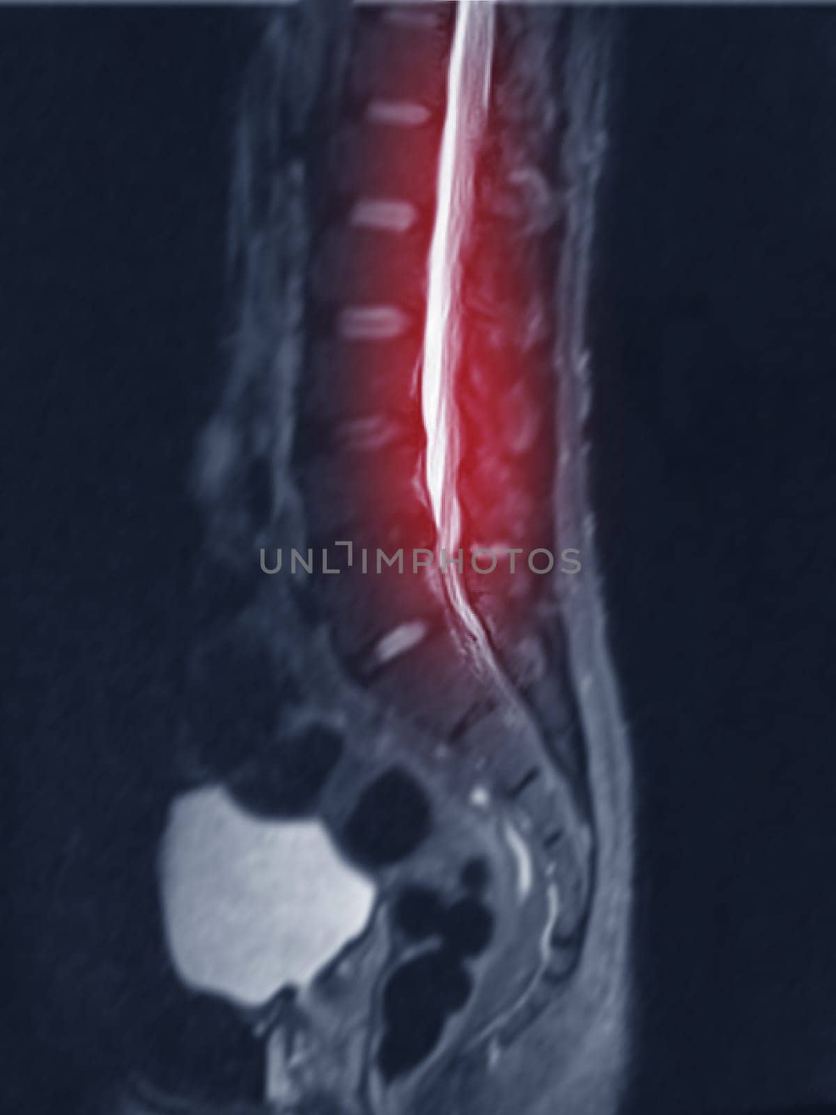 MRI L-S spine or lumbar spine Sagittall T2 FS view  for diagnosis spinal cord compression. by samunella