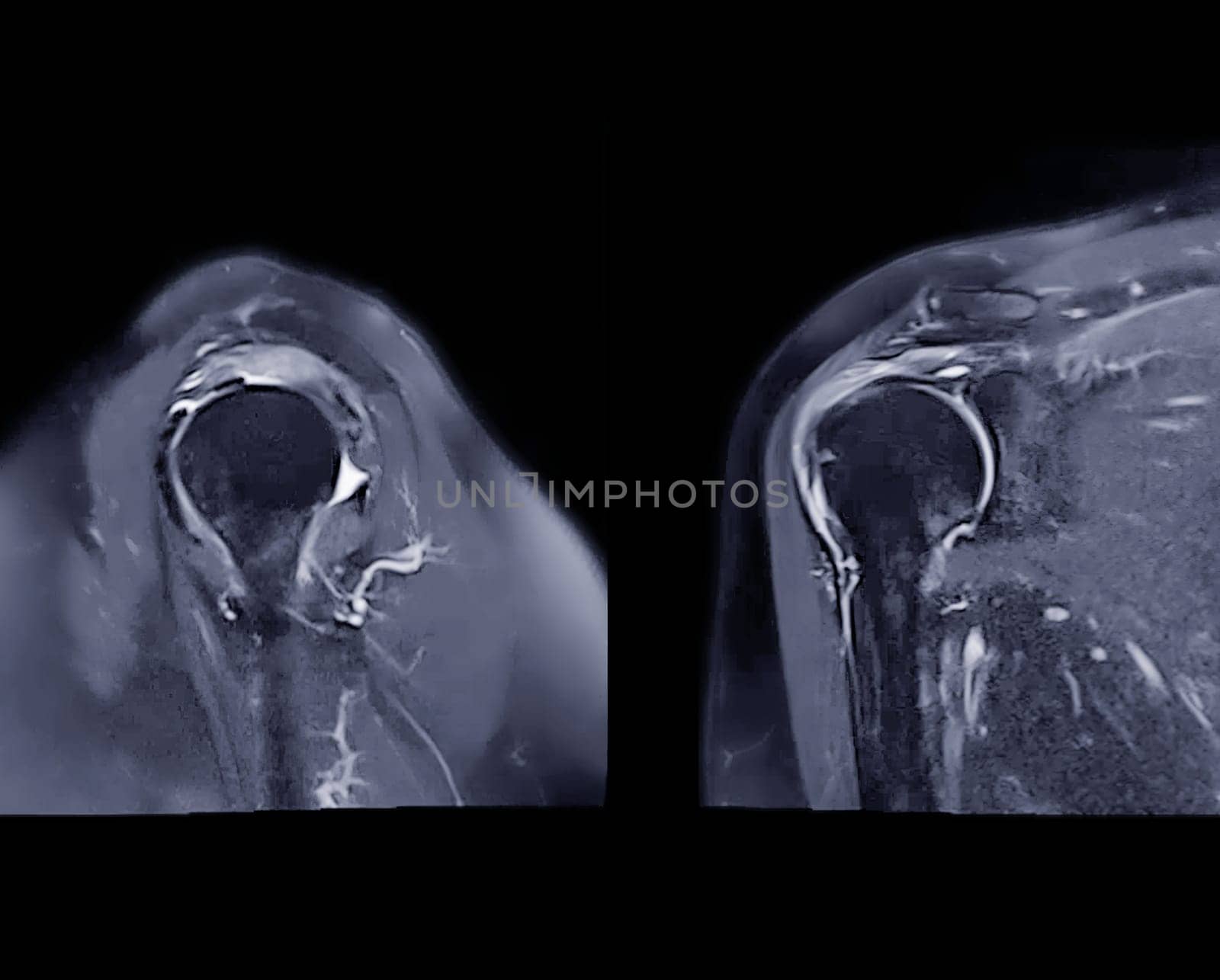 Magnetic Resonance Imaging or MRI of Shoulder Joint Sagittal and Coronal T2 FS  for diagnostic shoulder pain. by samunella