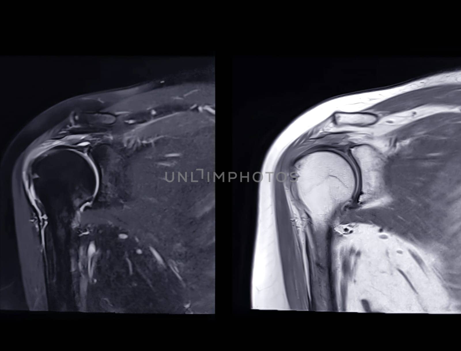 Magnetic Resonance Imaging or MRI of Shoulder Joint Coronal T2 FS and PDW for diagnostic shoulder pain. by samunella