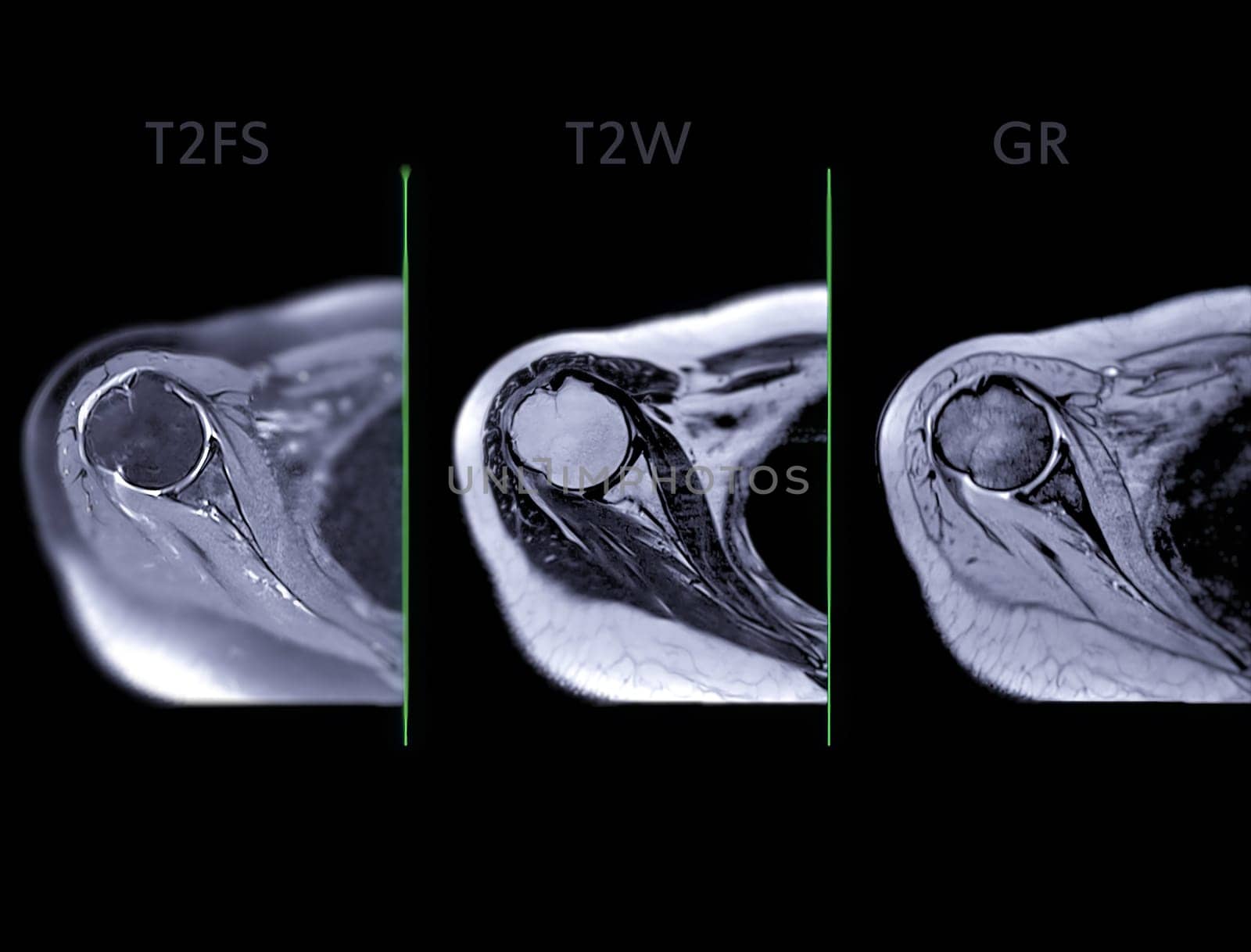 Magnetic Resonance Imaging or MRI of Shoulder Joint Axial T2FS,T2W and mFFE for diagnostic shoulder pain. by samunella