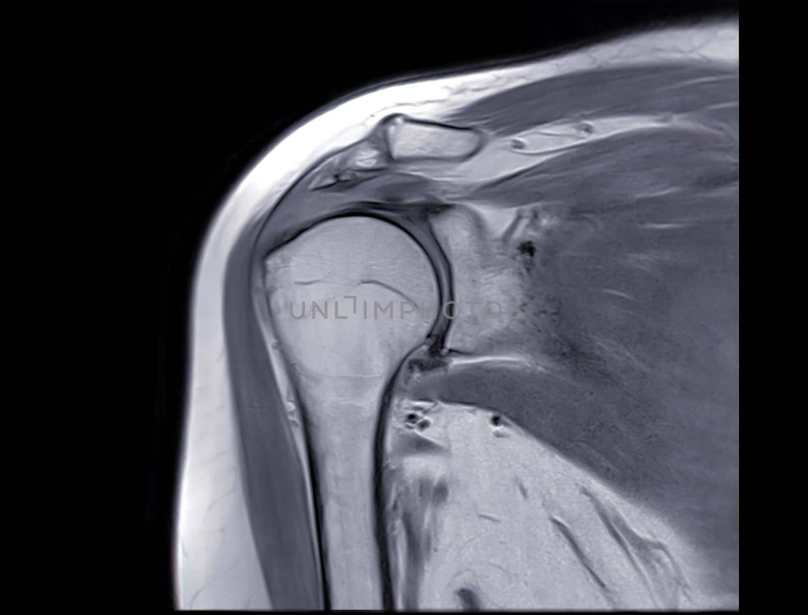 Magnetic Resonance Imaging or MRI of Shoulder Joint Coronal PDW for diagnostic shoulder pain. by samunella