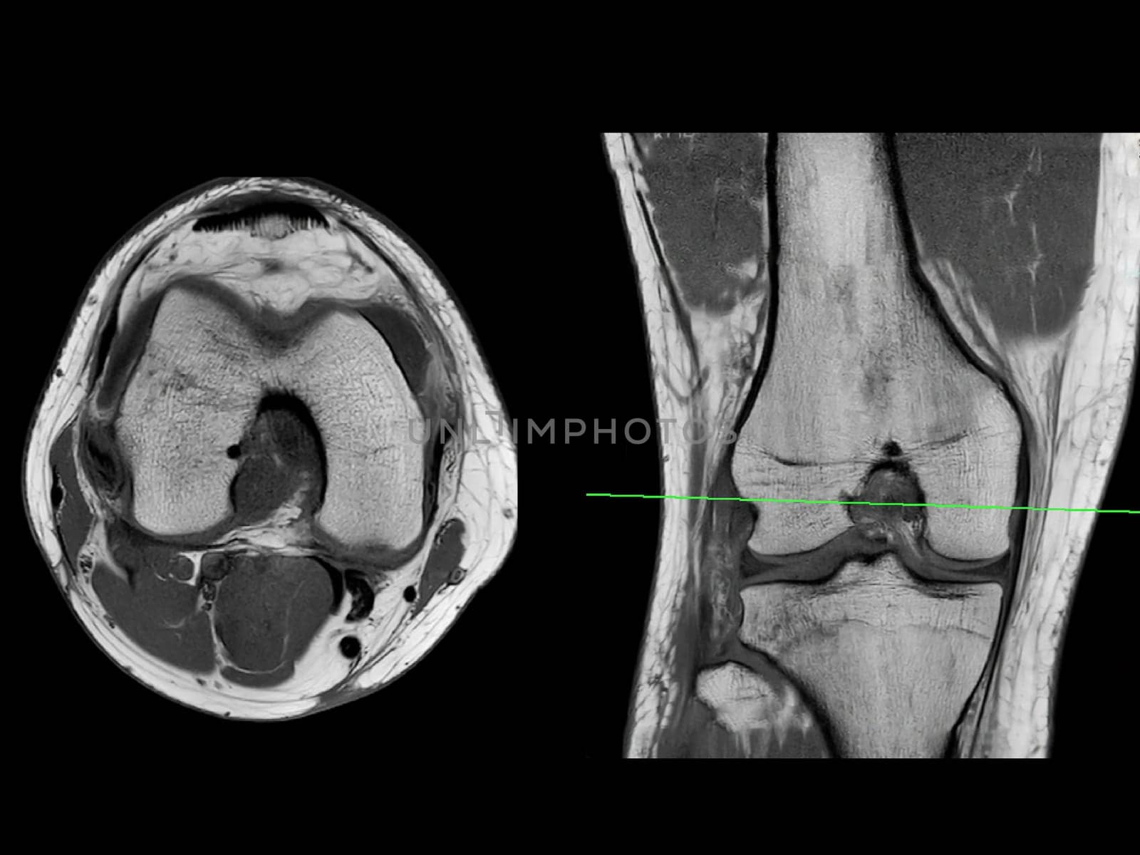 Magnetic resonance imaging or MRI of  knee joint Axial T2  and Coronal view for detect tear or sprain of the anterior cruciate  ligament (ACL) by samunella