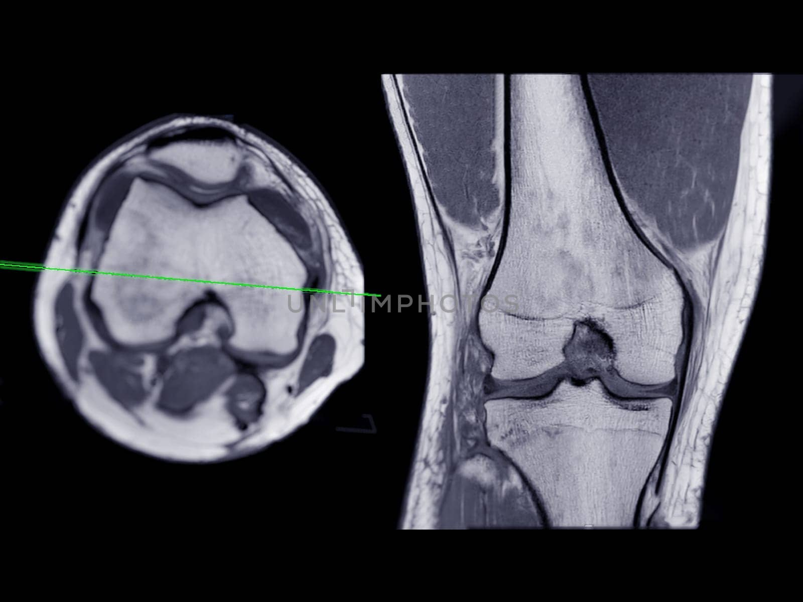 Magnetic resonance imaging or MRI of  knee joint Axial T2  and Coronal view for detect tear or sprain of the anterior cruciate  ligament (ACL) by samunella