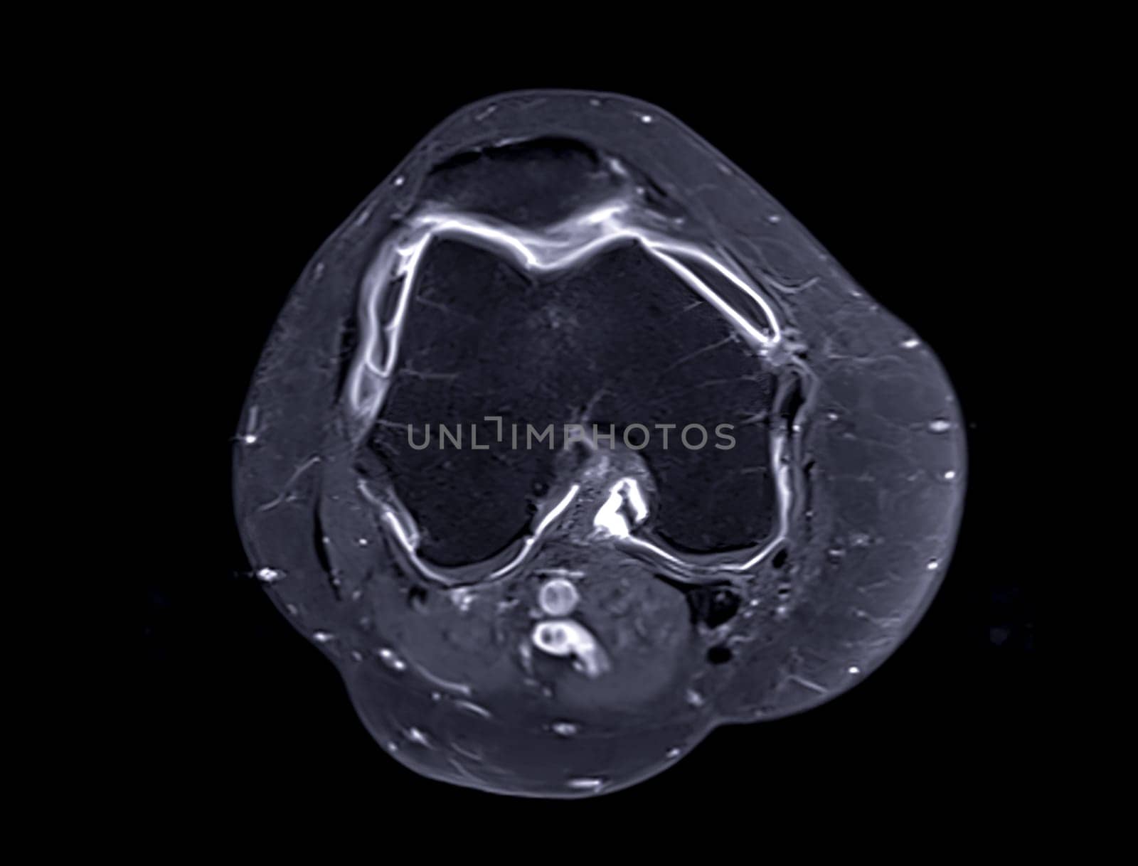 Magnetic resonance imaging or MRI of  knee joint Axial  view T2 FS with Gadolinium for detect tear or sprain of the anterior cruciate  ligament (ACL) by samunella