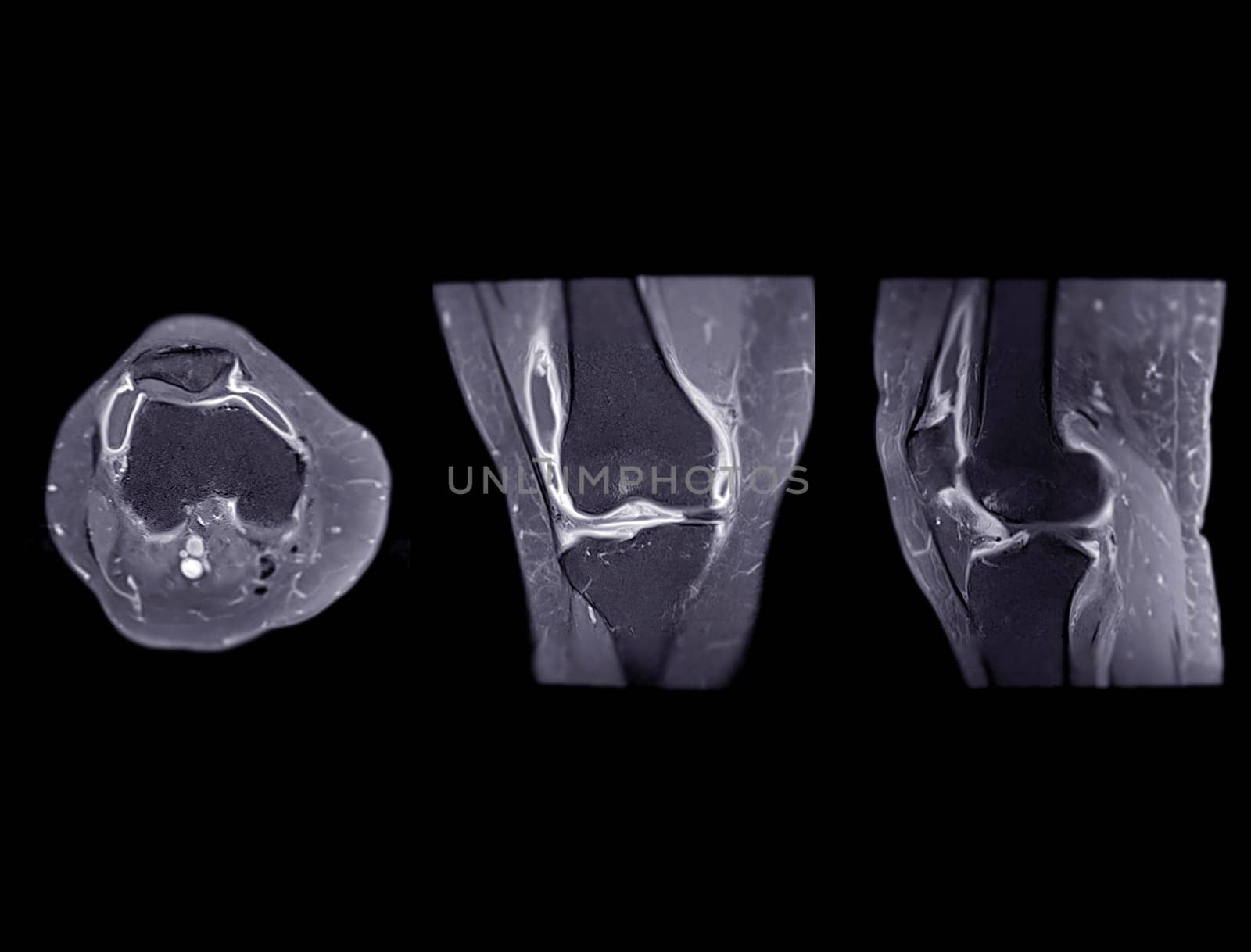 Magnetic resonance imaging or MRI of  knee joint Axial ,Coronal and sagittal T2 FS for detect tear or sprain of the anterior cruciate  ligament (ACL)