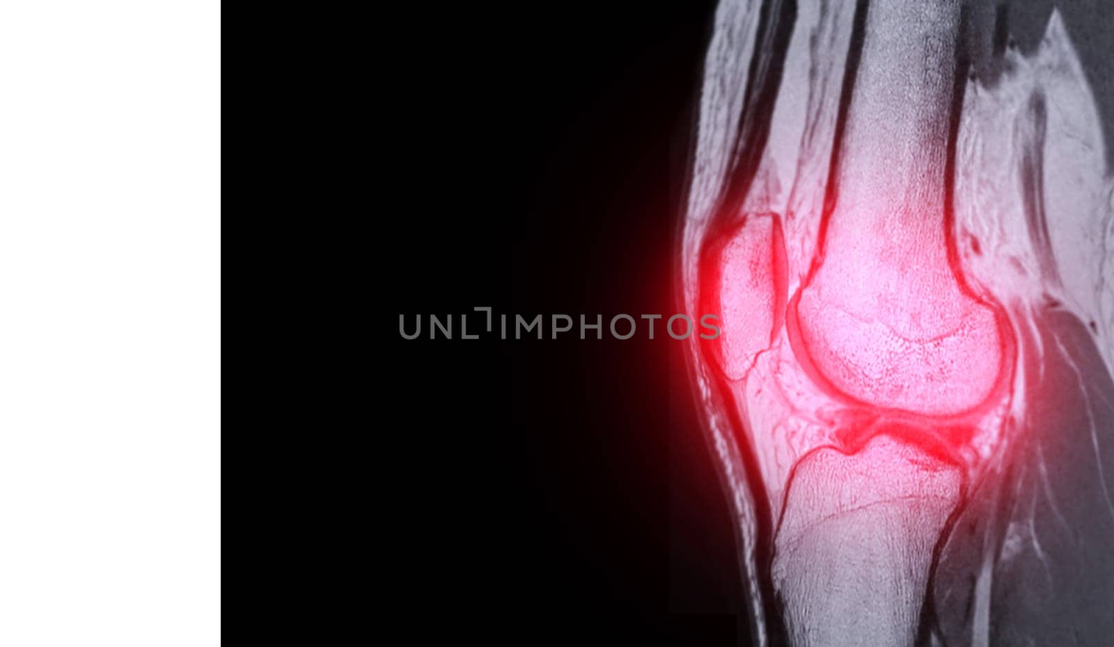 Magnetic resonance imaging or MRI of  knee joint  sagittal  PDW for detect tear or sprain of the anterior cruciate  ligament (ACL)