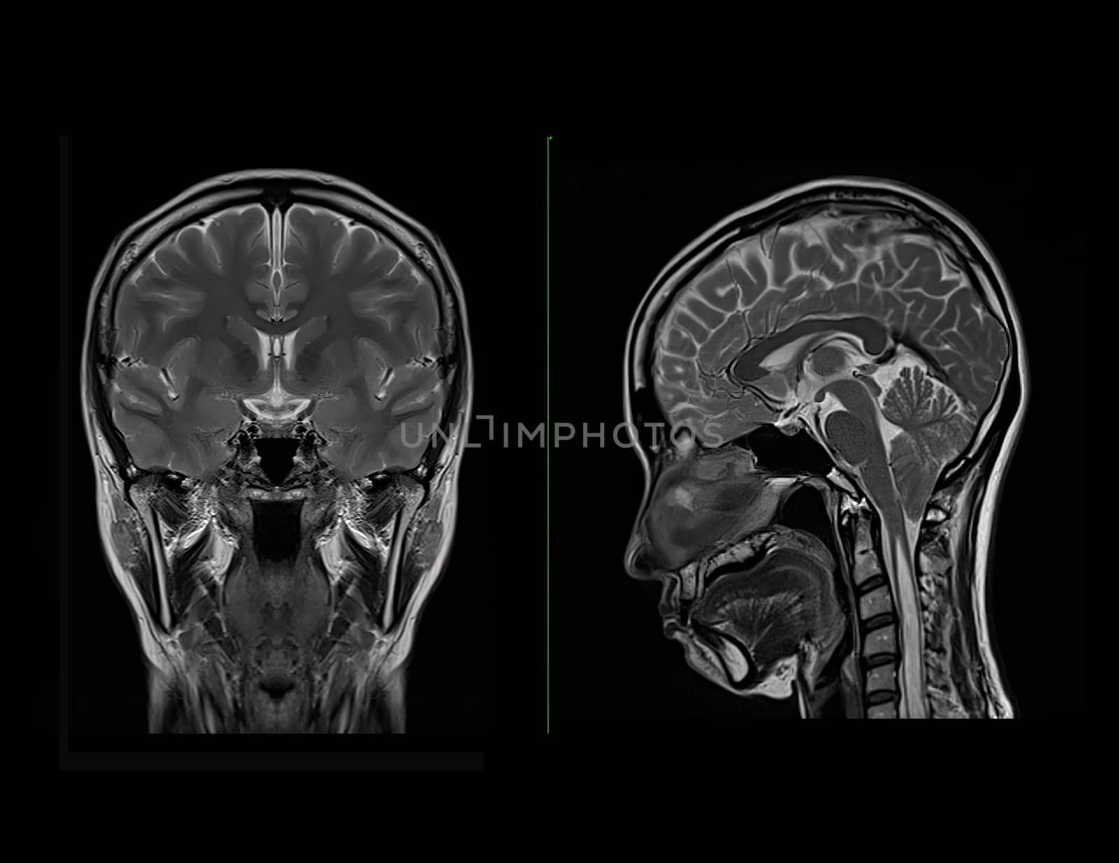 MRI  brain scan  Compare Coronal and sagittal plane for detect  Brain  diseases sush as stroke disease, Brain tumors and Infections. by samunella