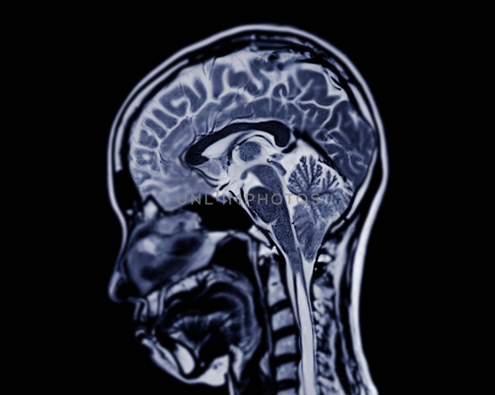 MRI  brain scan  sagittal plane for detect  Brain  diseases sush as stroke disease, Brain tumors and Infections.