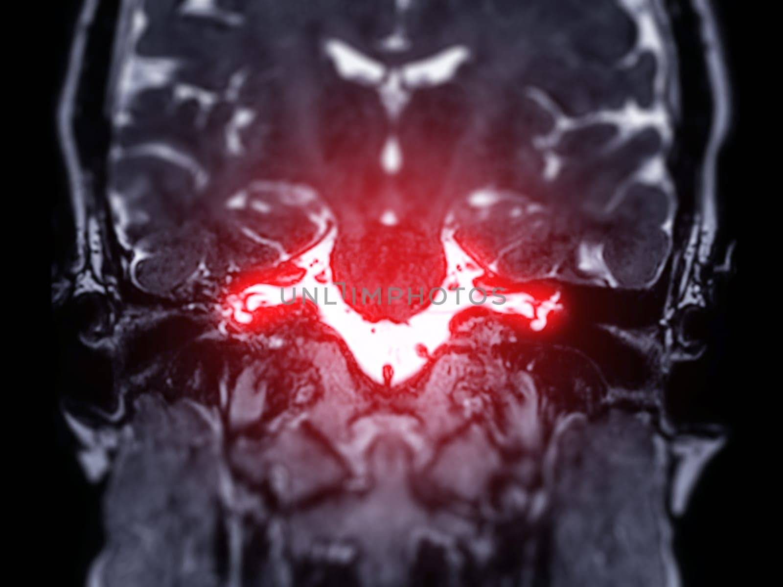 MRI Brain scan  with  the internal auditory canal (IAC) Coronal view.  by samunella