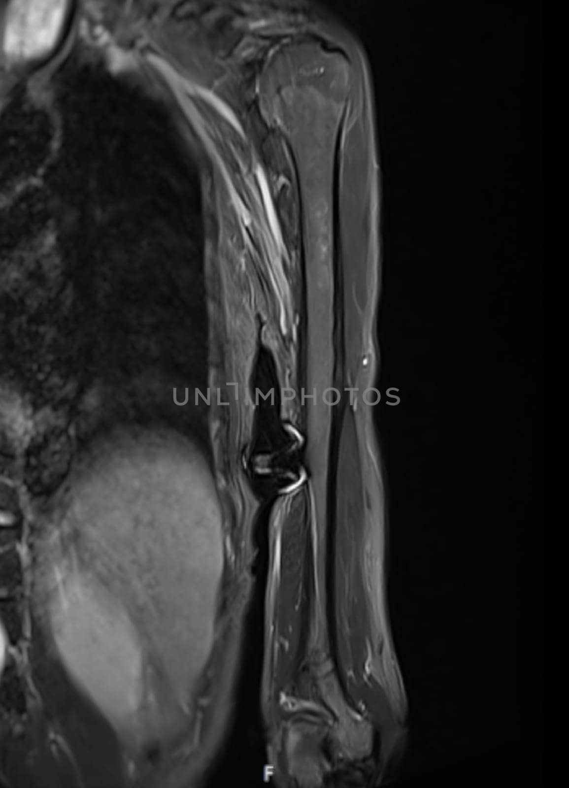 MRI Left humerus bone for diagnosis bone tumor. by samunella