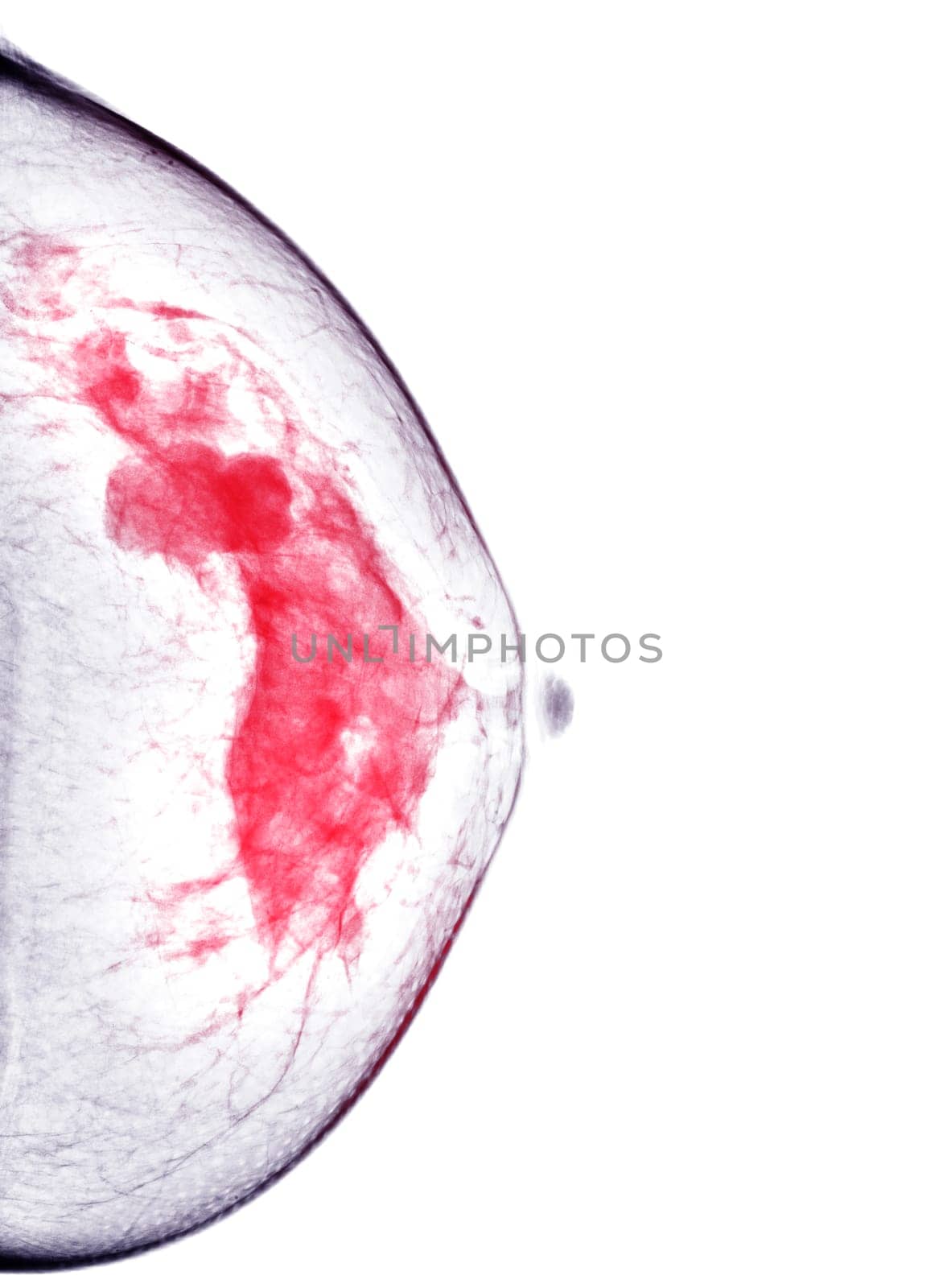  X-ray Digital Mammogram Left side  CC view .  by samunella