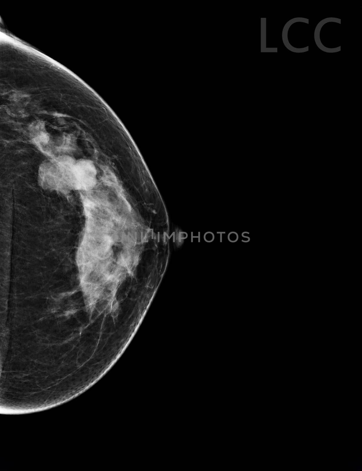 X-ray Digital Mammogram Left side CC view . mammography or breast scan for Breast cancer BI-RADS 5; Highly suggestive of malignancy .