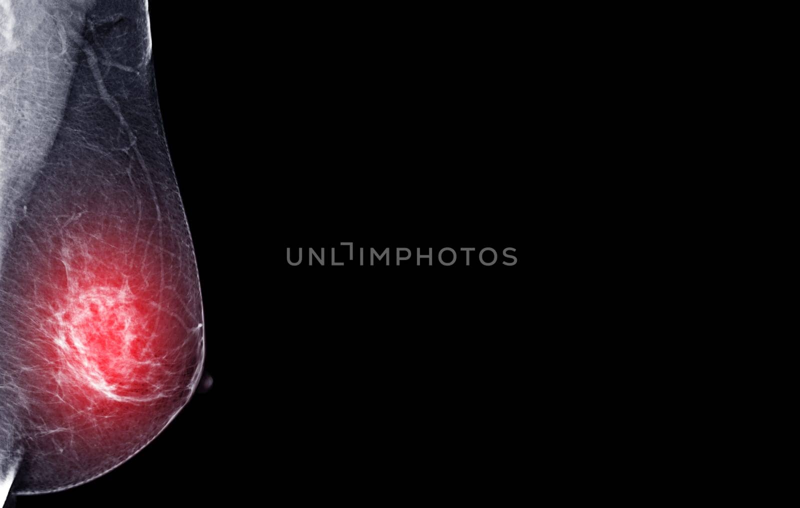  X-ray Digital Mammogram of Right  side  MLO view .  by samunella
