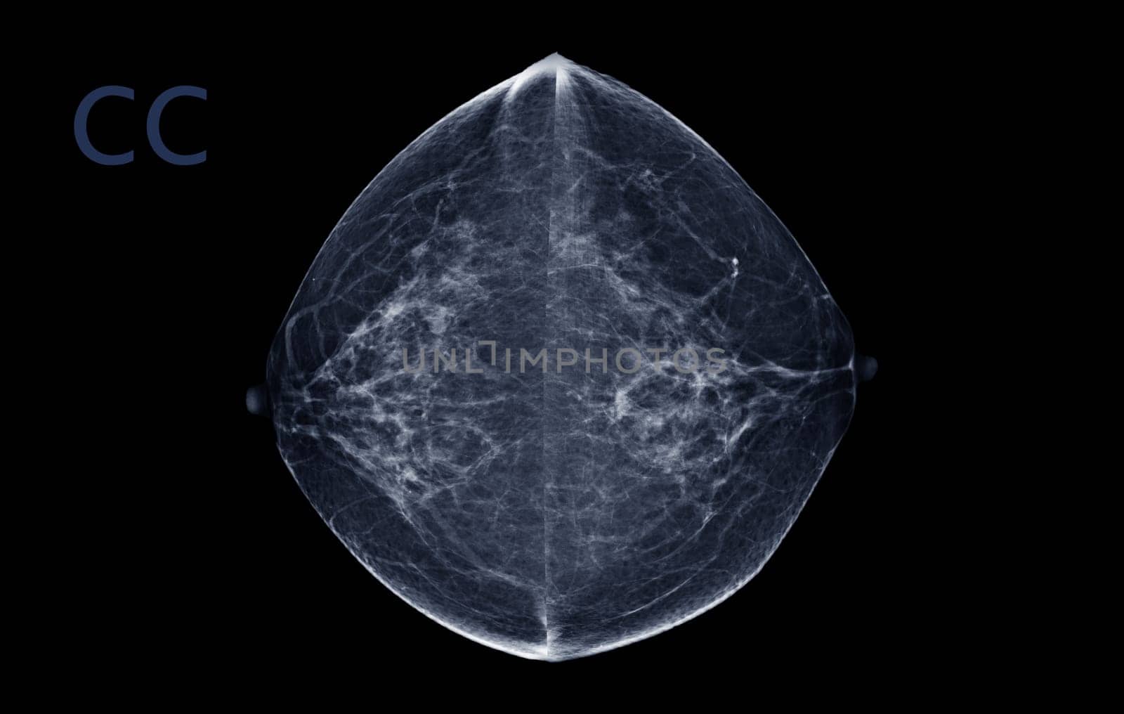 X-ray Digital Mammogram of Both  side  CC view . mammography or breast scan for Breast cancer  showing BI-RADS CATEGORY 2  Benign tumor.