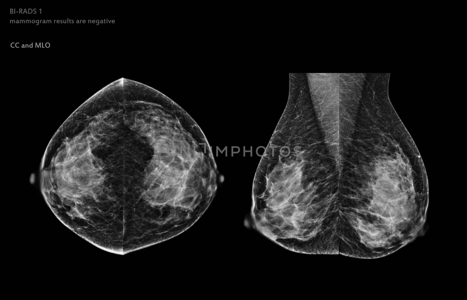  X-ray Digital Mammogram of Both side CC view and MLO view. mammography or breast scan for Breast cancer BI-RADS 1 mammogram results are negative.