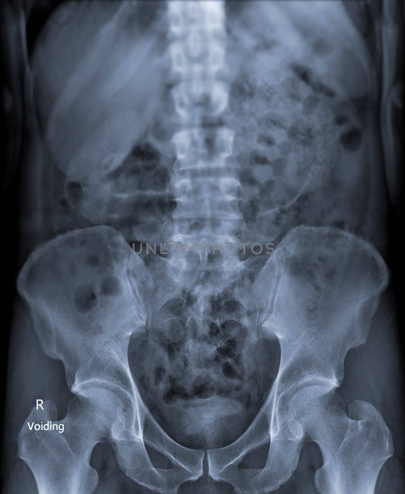  Intravenous pyelogram or I.V.P is an X-ray exam of urinary tract after injection contrast media agent  .