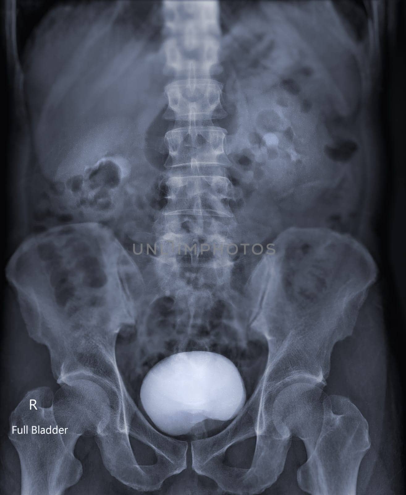  Intravenous pyelogram or I.V.P is an X-ray exam of urinary tract after injection contrast media agent  .