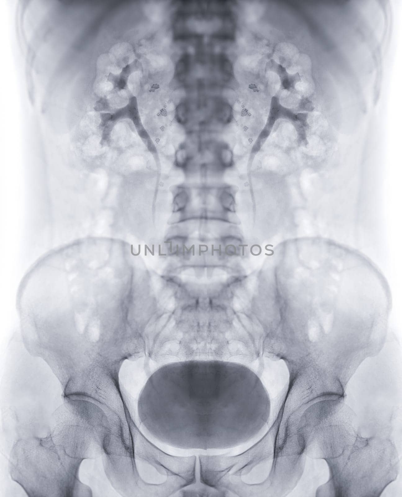  Intravenous pyelogram or I.V.P is an X-ray exam of urinary tract after injection contrast media agent  .