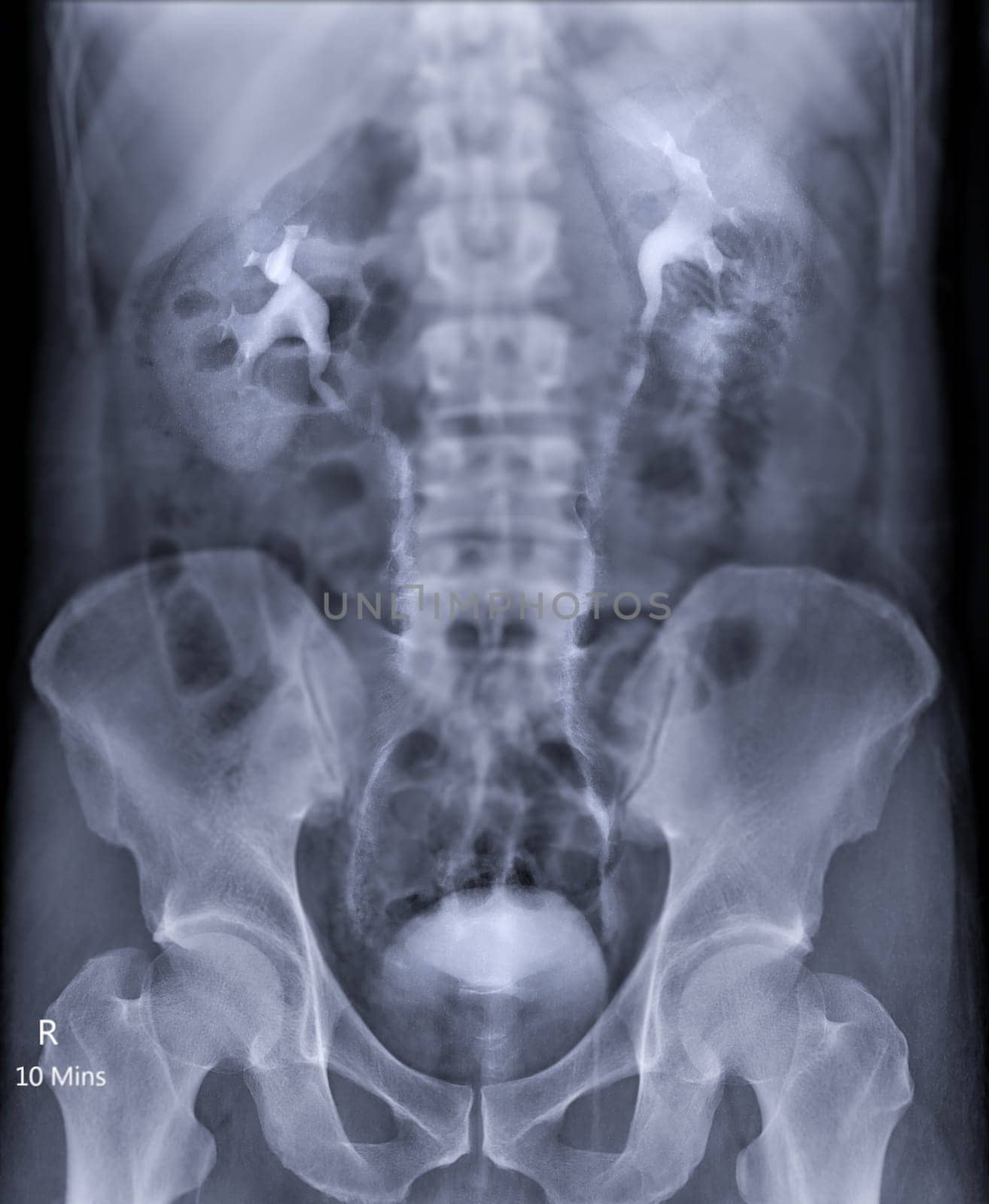  Intravenous pyelogram or I.V.P is an X-ray exam of urinary tract after injection contrast media agent  .