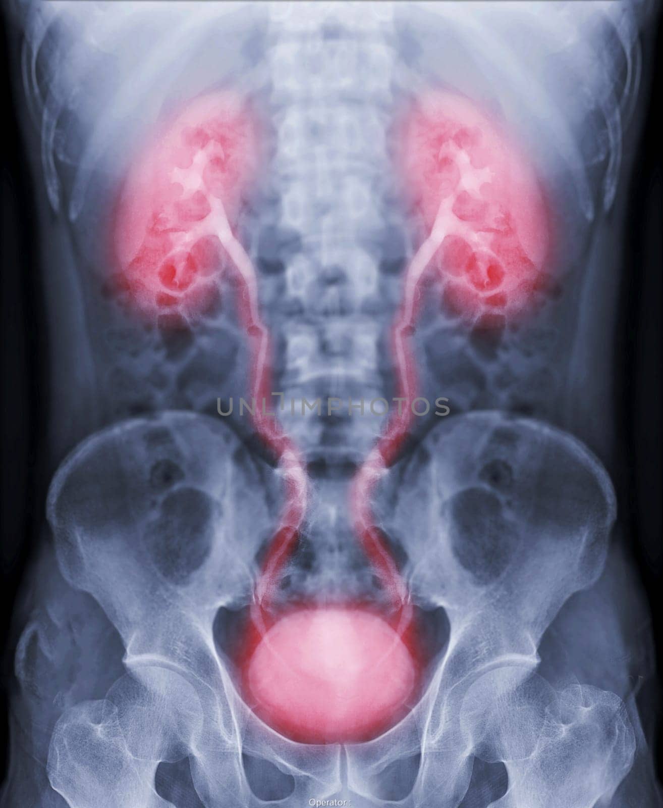  Intravenous pyelogram or I.V.P is an X-ray exam of urinary tract after injection contrast media agent  .