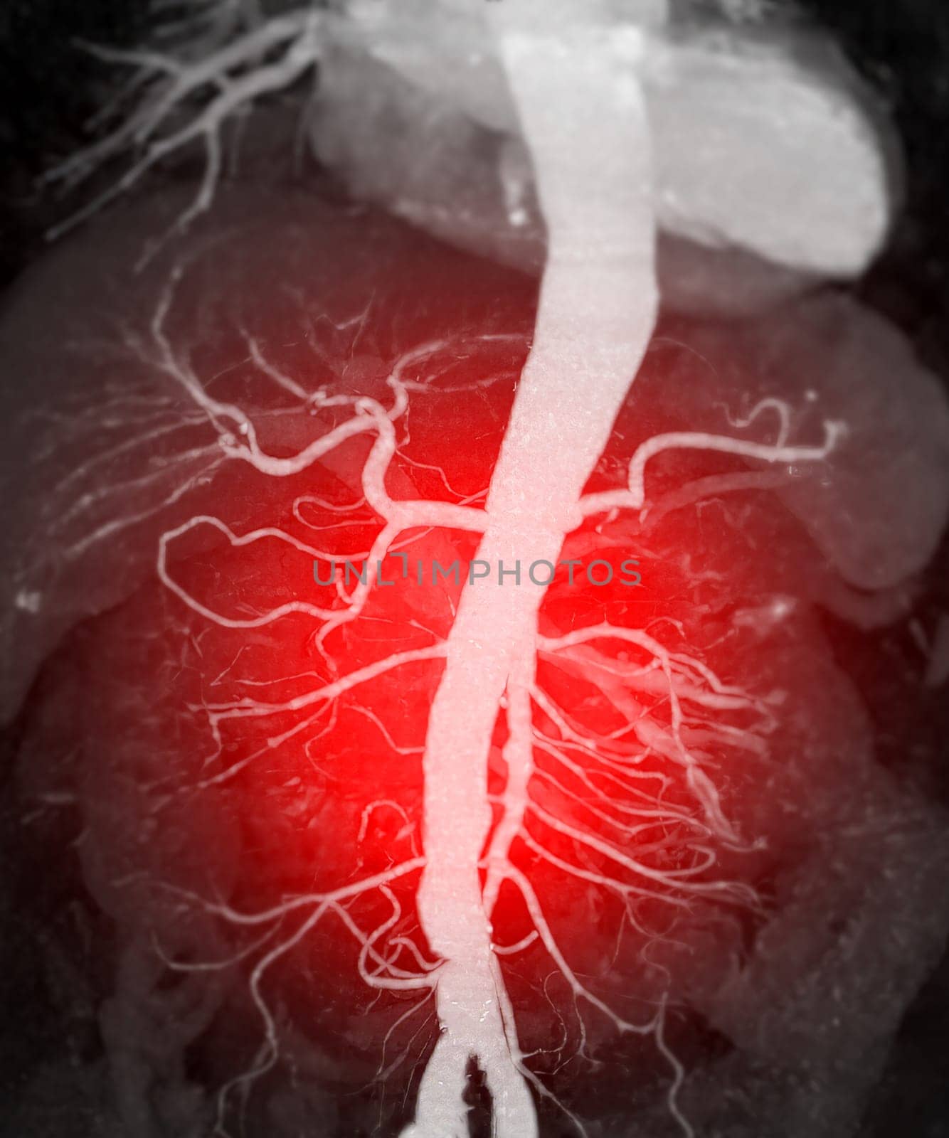 CTA whole aorta 3D rendering.