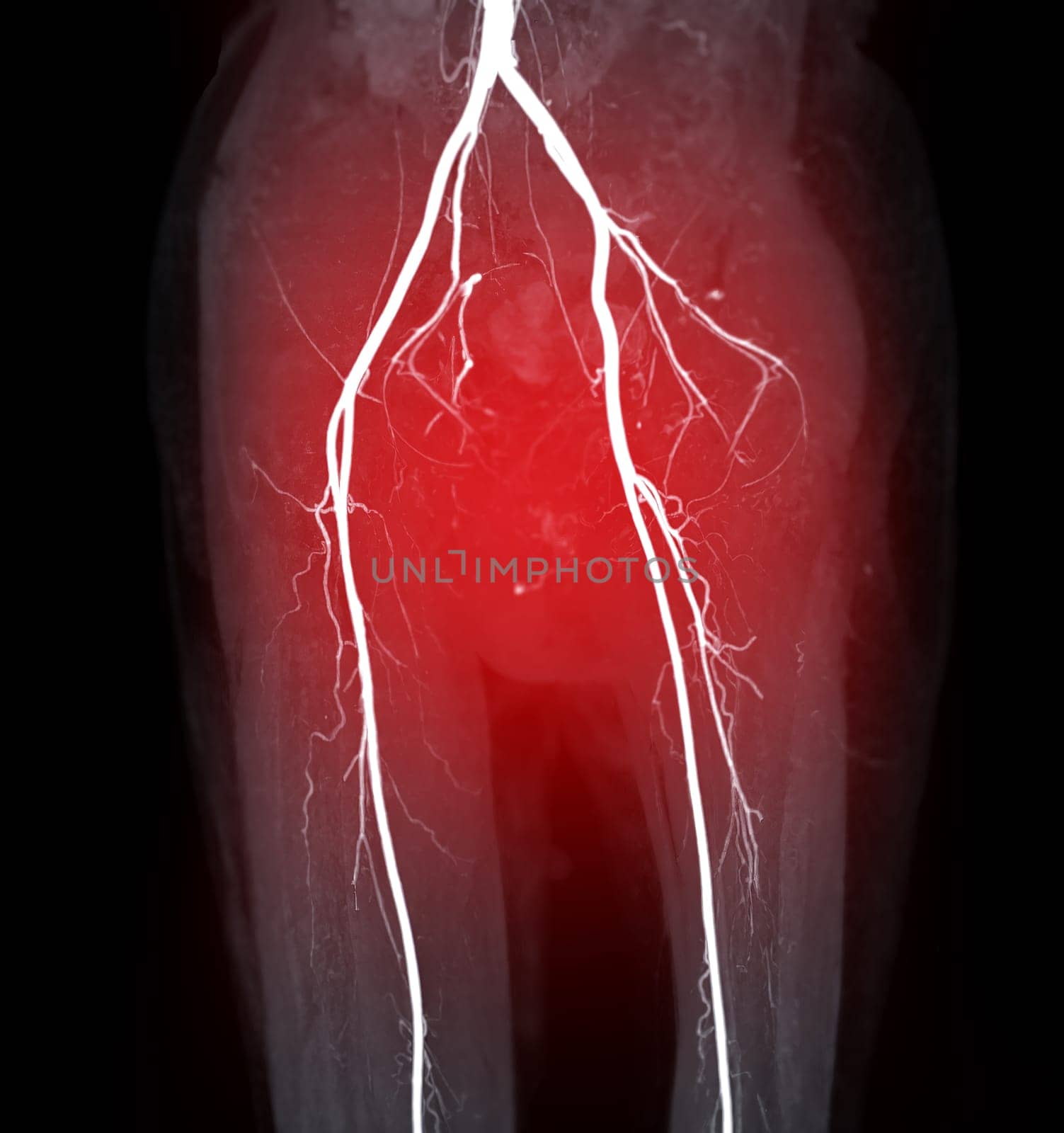 CTA femoral artery run off image of femoral artery for diagnostic  Acute or Chronic Peripheral Arterial Disease.