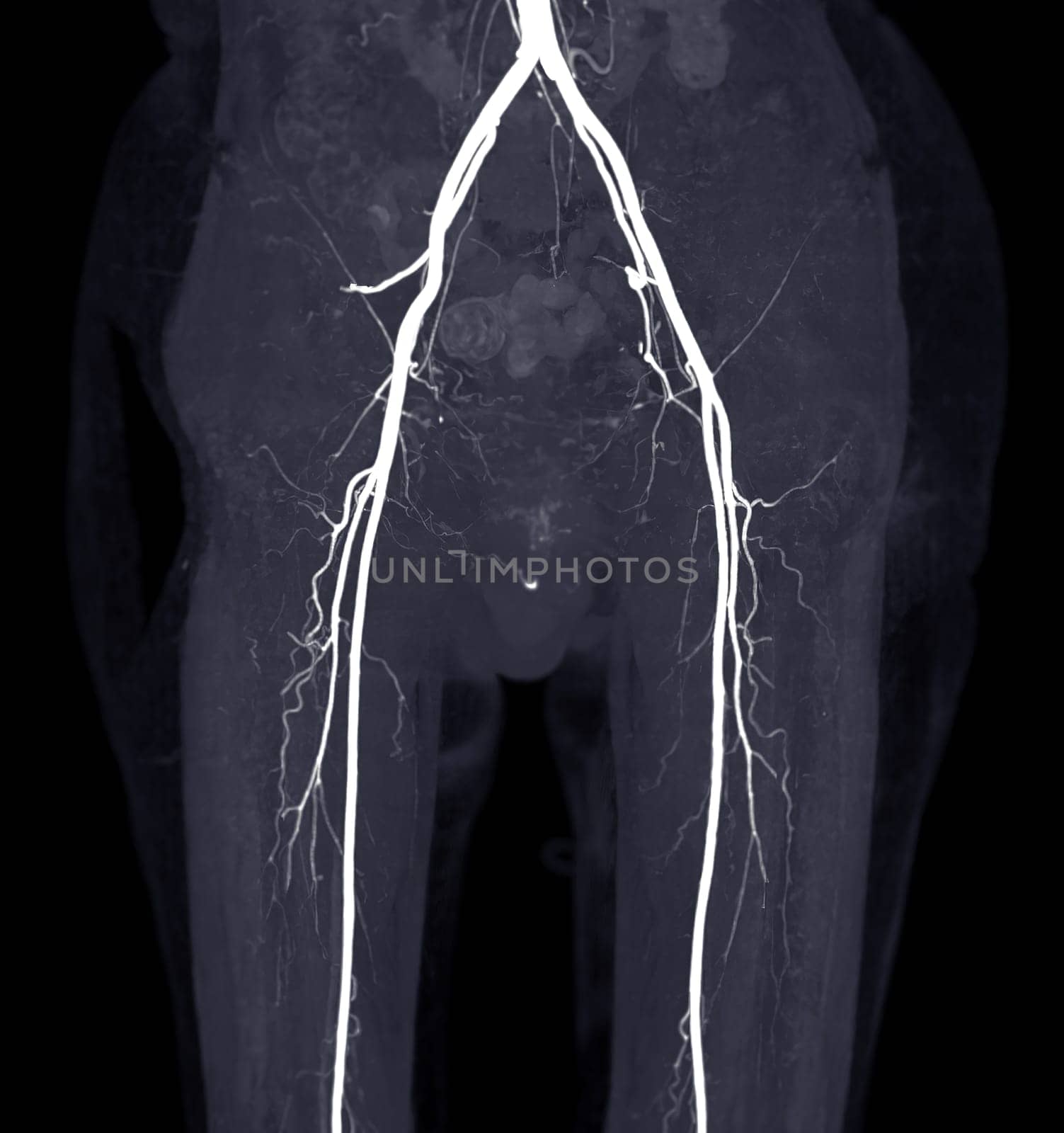 CTA femoral artery run off image of femoral artery for diagnostic  Acute or Chronic Peripheral Arterial Disease.