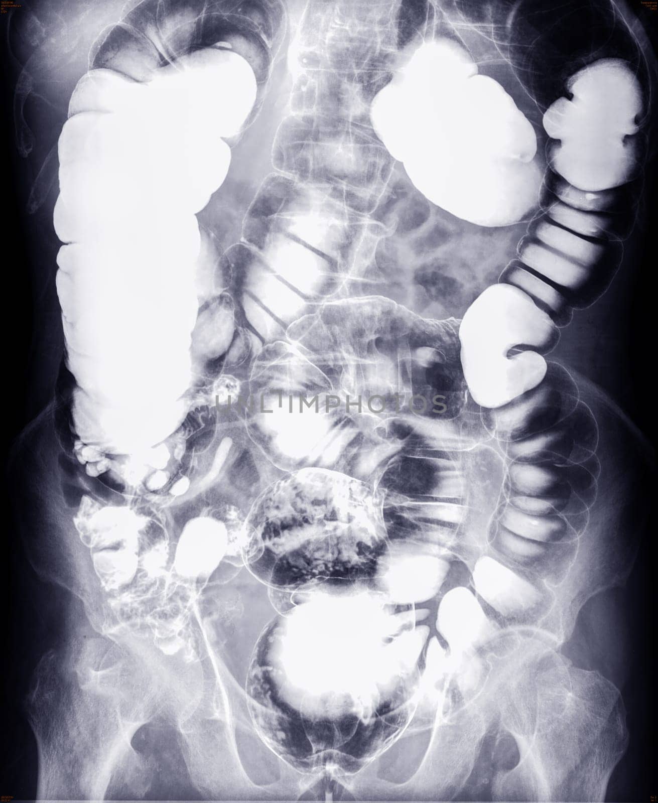 Barium enema study image or x-ray image of large intestine .