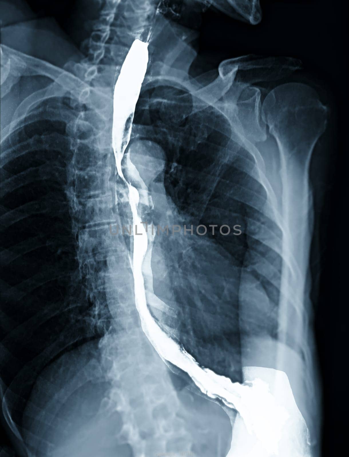 Barium Swallow study test diagnose Barrett's GI tract exam GERD ulcers series difficulty pharynx procedure UGI throat bowel therapy by fluoroscopy devices.