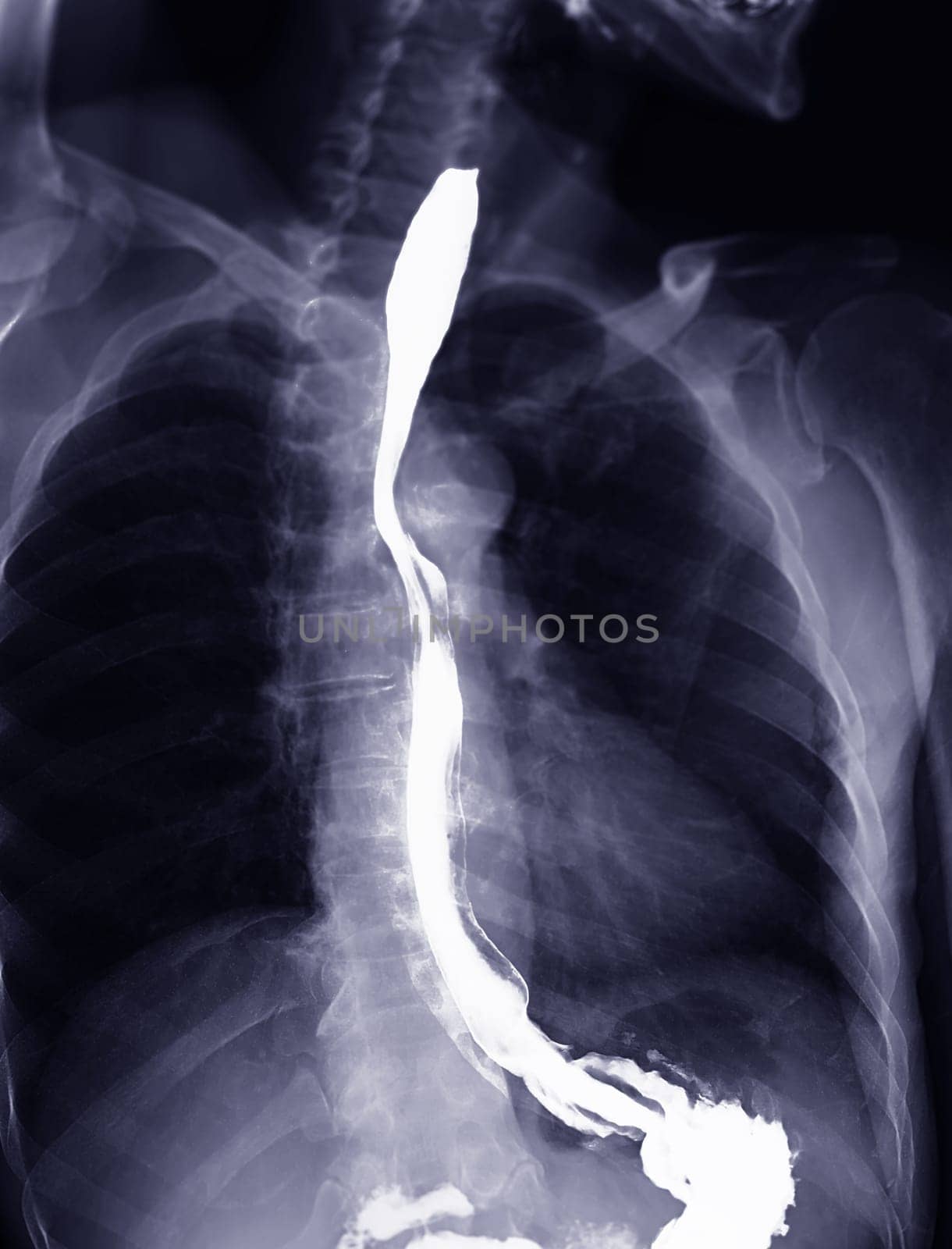 Barium Swallow study test diagnose Barrett's GI tract exam GERD ulcers series difficulty pharynx procedure UGI throat bowel therapy by fluoroscopy devices.