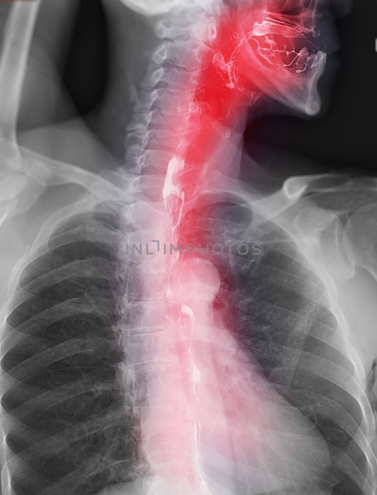 Barium Swallow study test diagnose Barrett's GI tract exam GERD ulcers series difficulty pharynx procedure UGI throat bowel therapy by fluoroscopy devices.