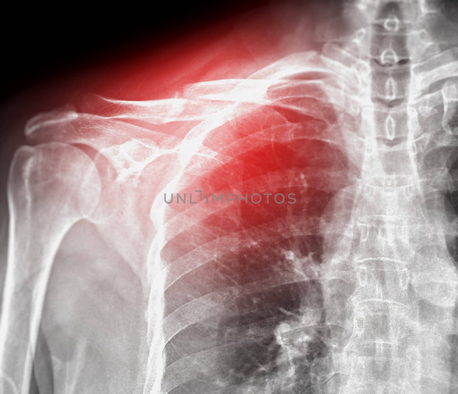 X-ray of Clavicle bone  showing fracture of  Clavicle bone  .