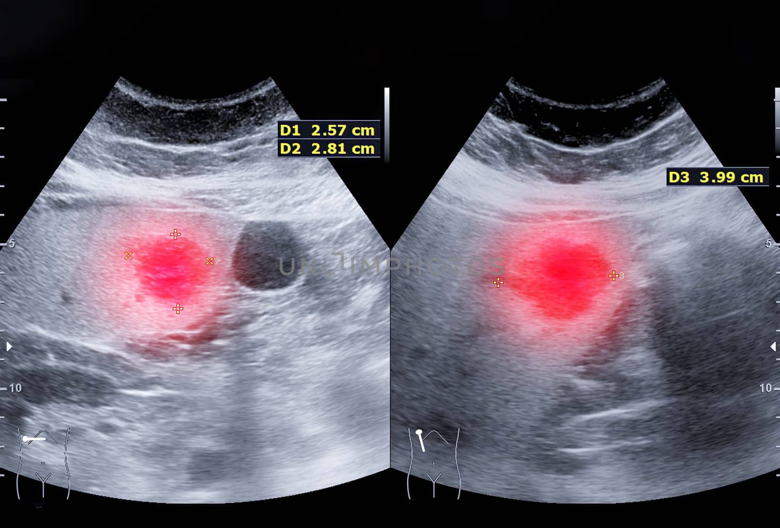 Ultrasound upper abdomen for diagnosis abdominal pain.