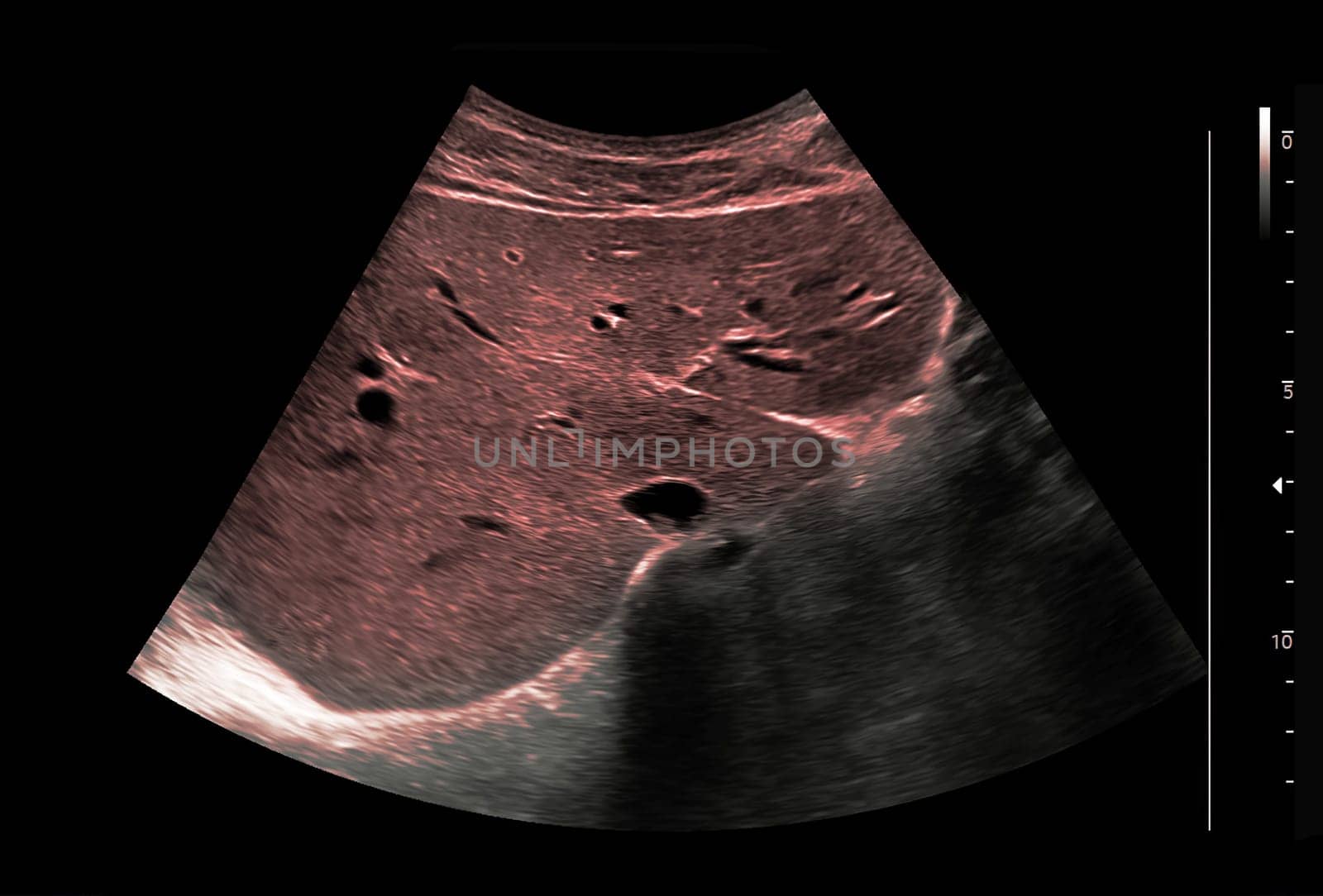 Ultrasound upper abdomen for diagnosis abdominal pain. by samunella