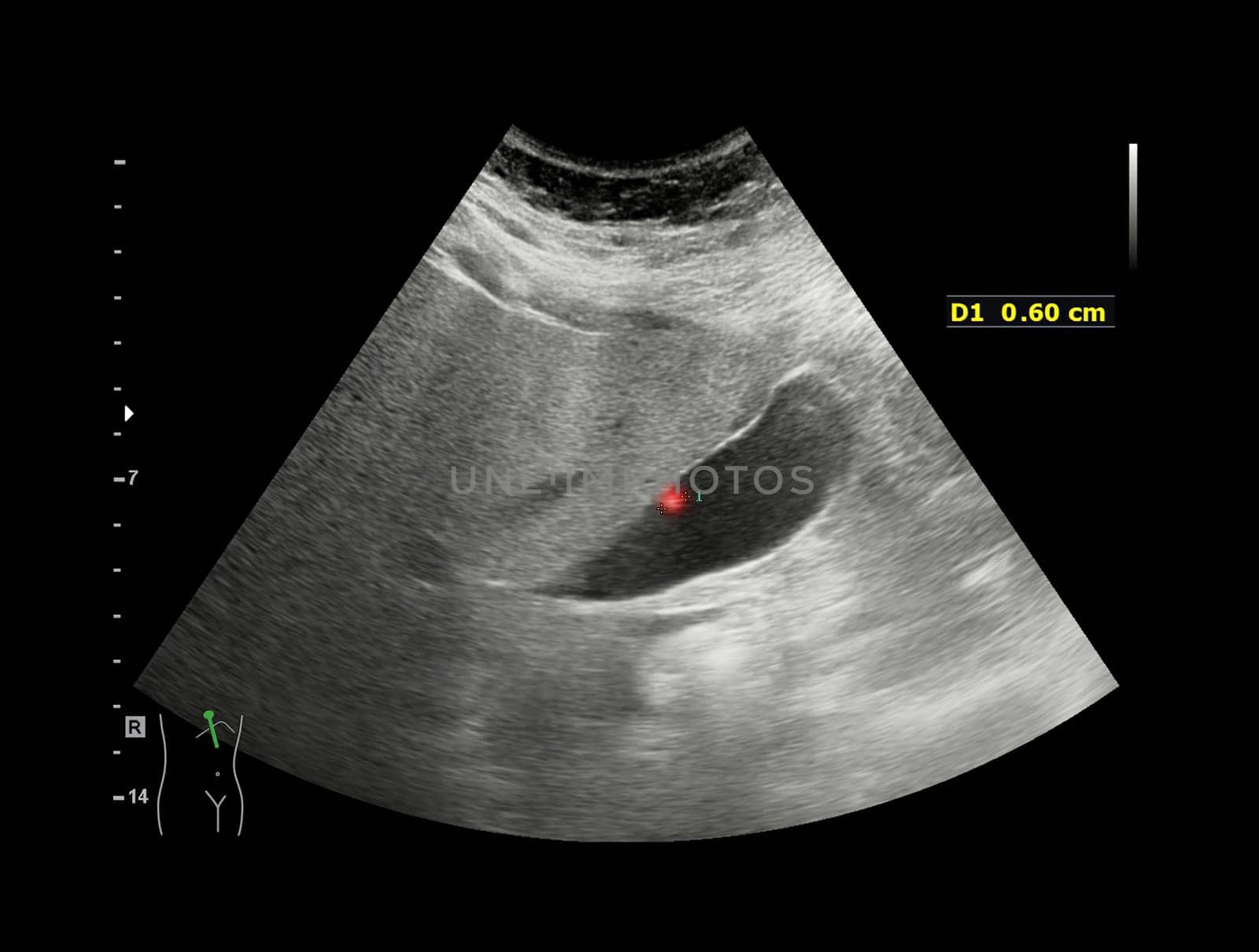 Ultrasound upper abdomen for diagnosis abdominal pain.