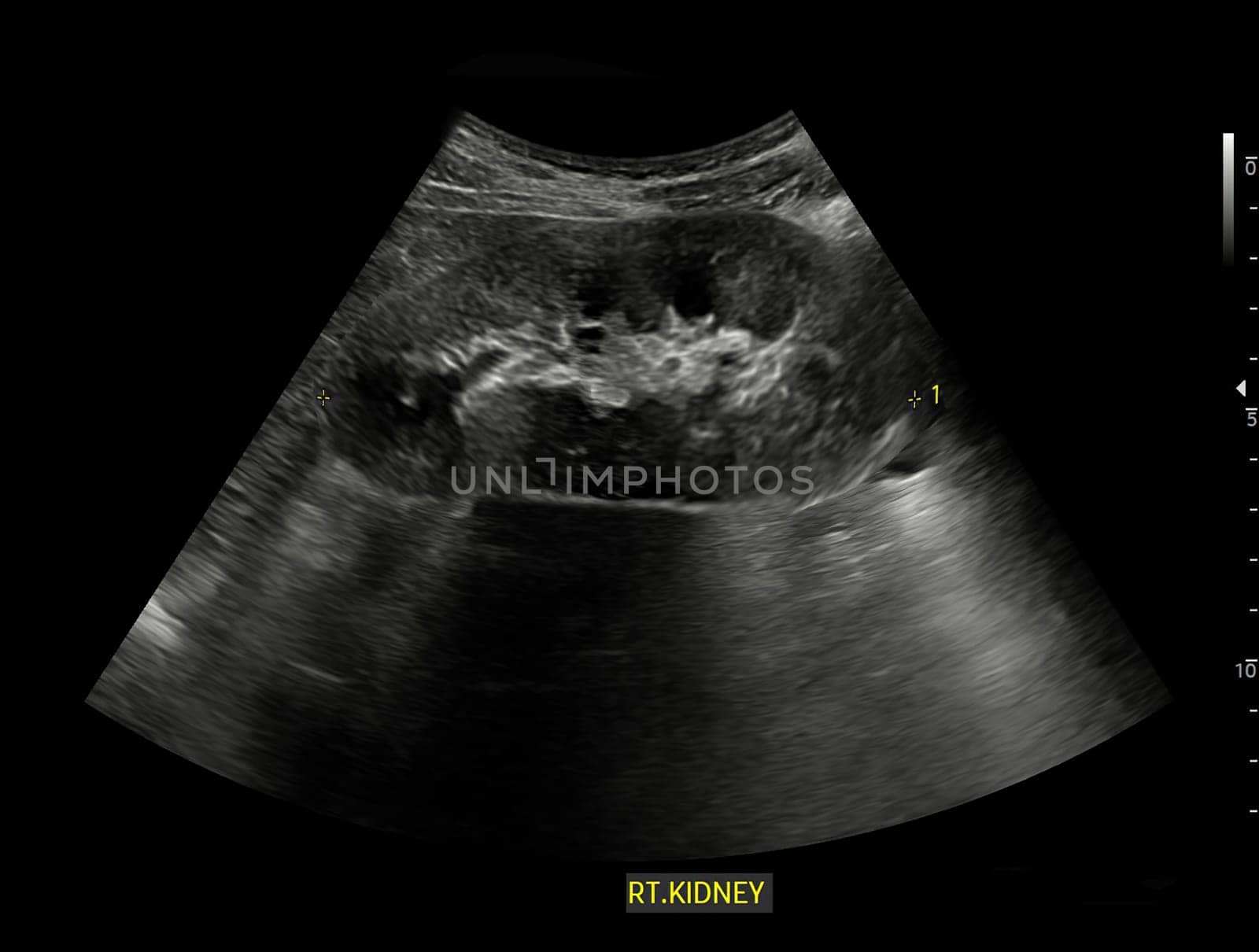 Ultrasound of Kidney  or KUB  for  screening  renal stone disease or Urolithiasis. by samunella