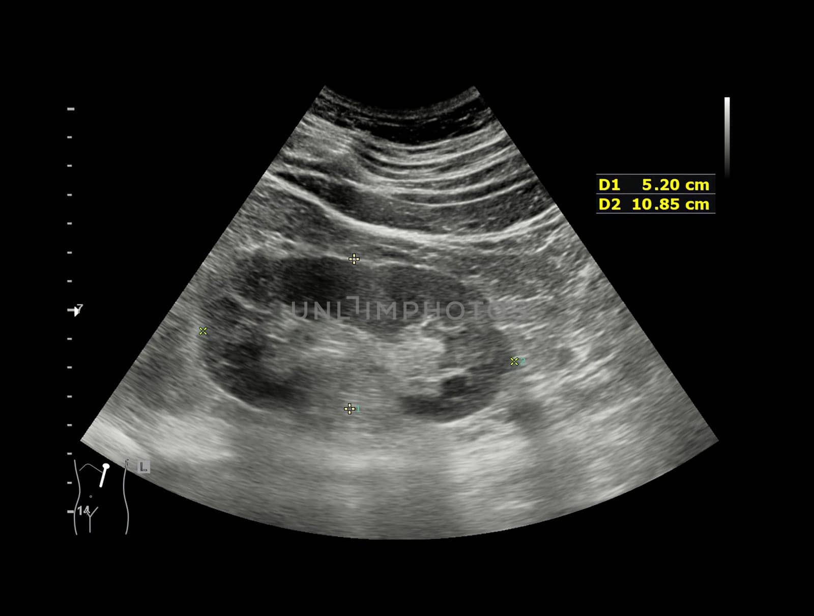 Ultrasound of Kidney  or KUB  for  screening  renal stone disease or Urolithiasis.