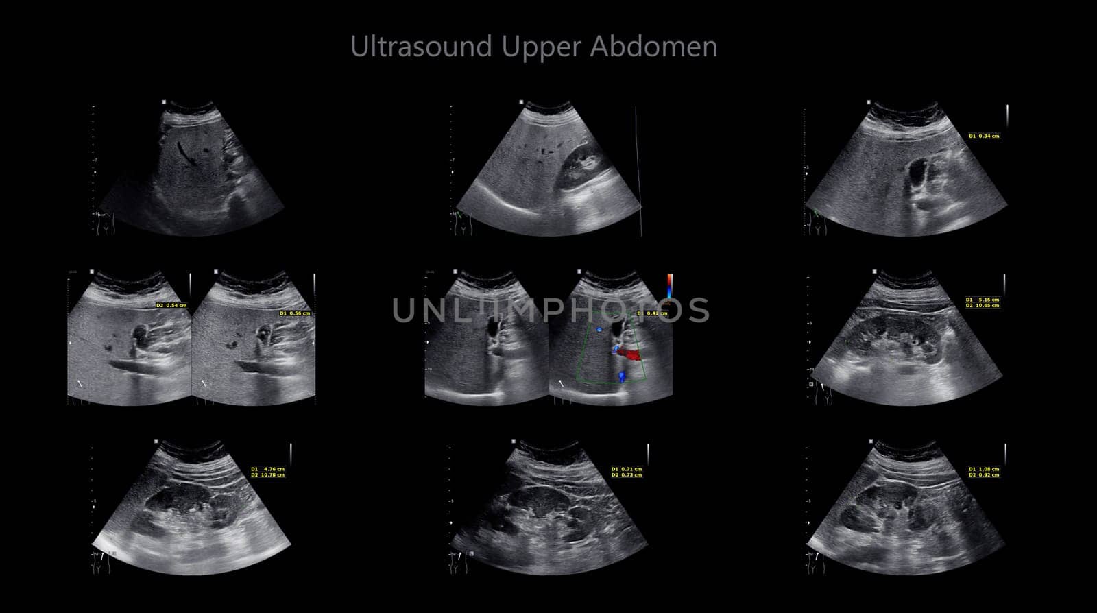 Ultrasound upper abdomen showing  Liver and gall bladder for screening hepatic cell carcinoma and gallstone.