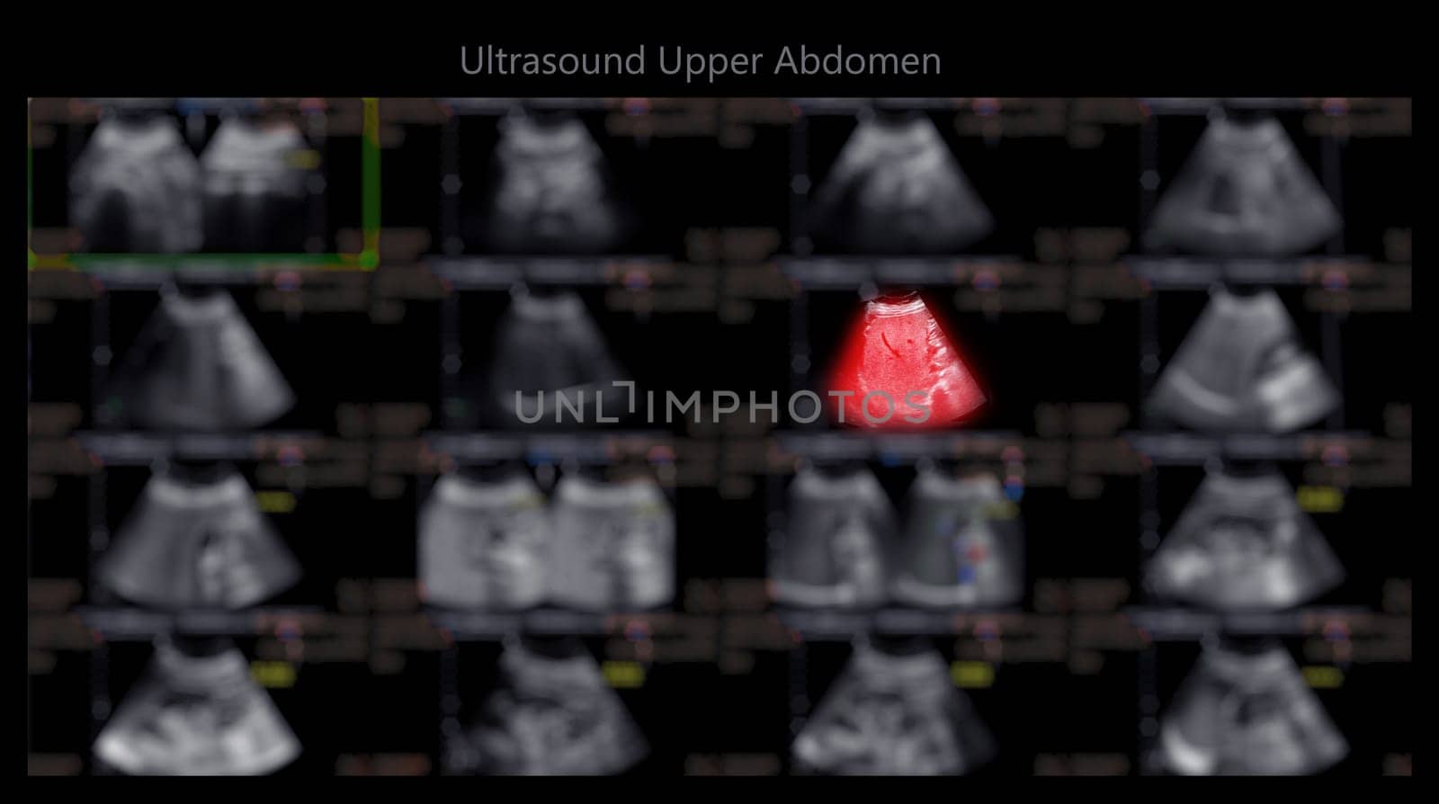 Ultrasound upper abdomen showing  Liver and gall bladder for screening hepatic cell carcinoma and gallstone.