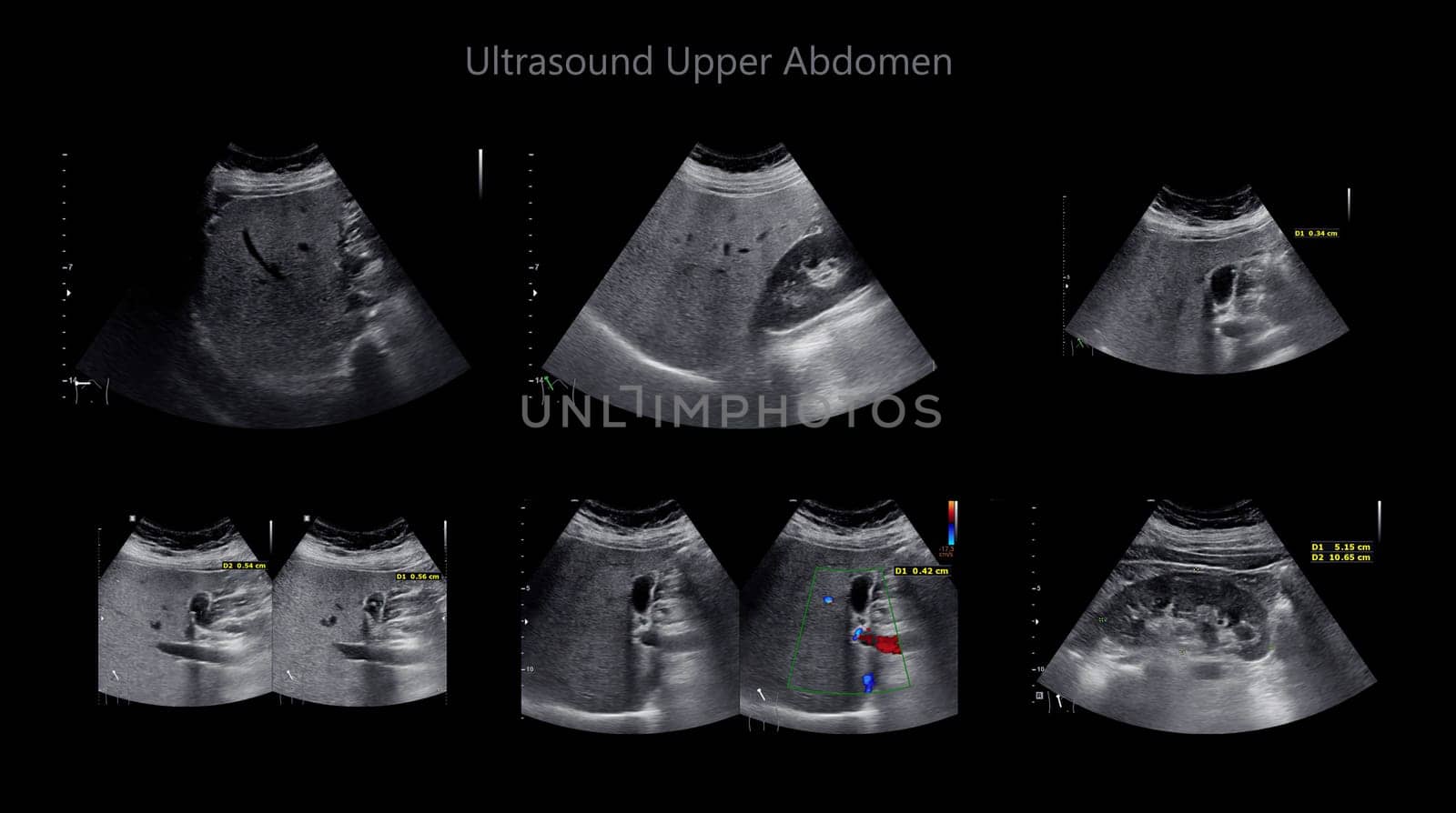 Ultrasound upper abdomen showing  Liver and gall bladder for screening hepatic cell carcinoma and gallstone. by samunella