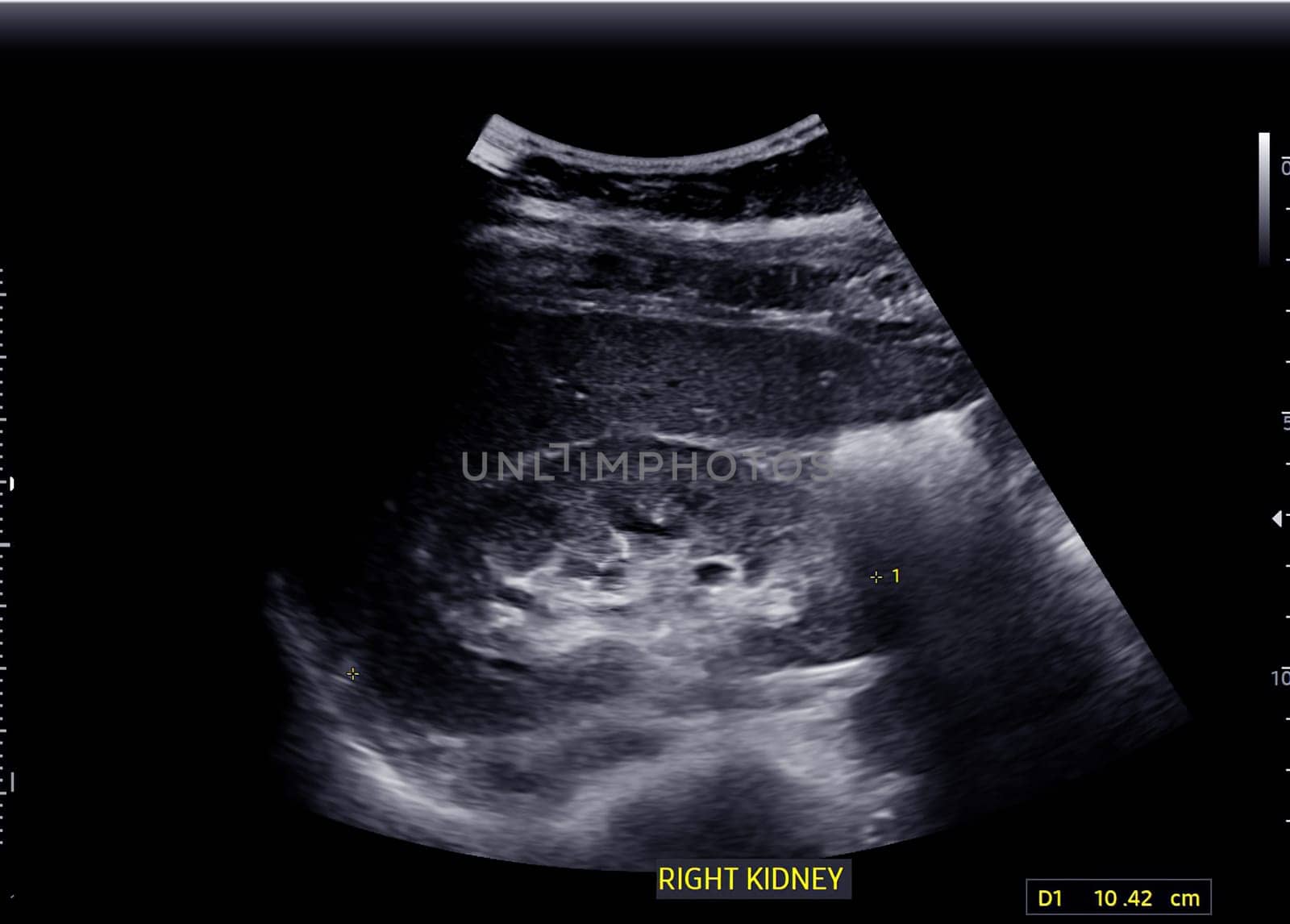 Ultrasound of Kidney  or KUB  for  screening  renal stone disease. by samunella