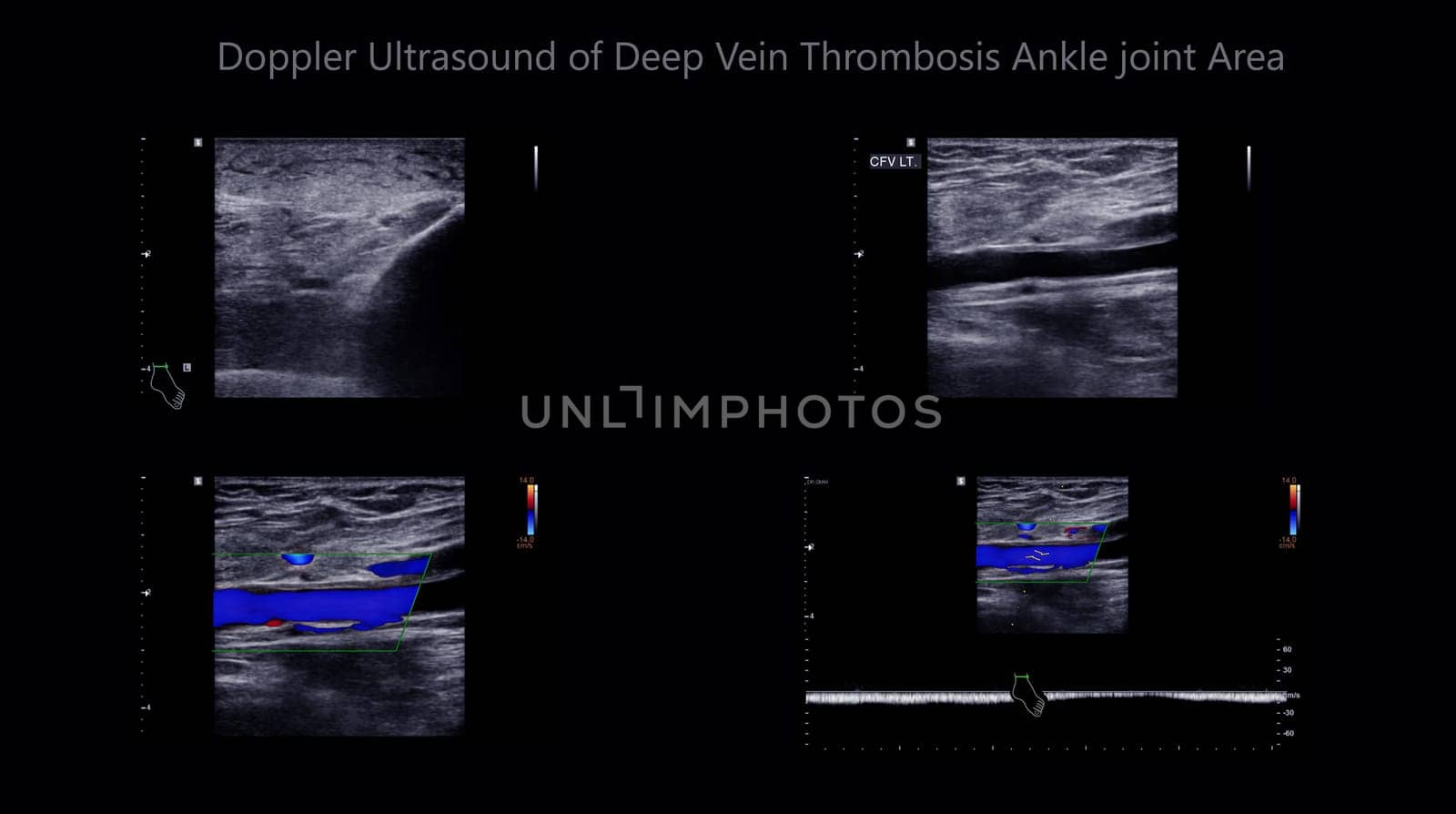 Color Doppler ultrasound determination in deep vein thrombosis patients for finding  deep vein thrombosis of lower extremity. by samunella