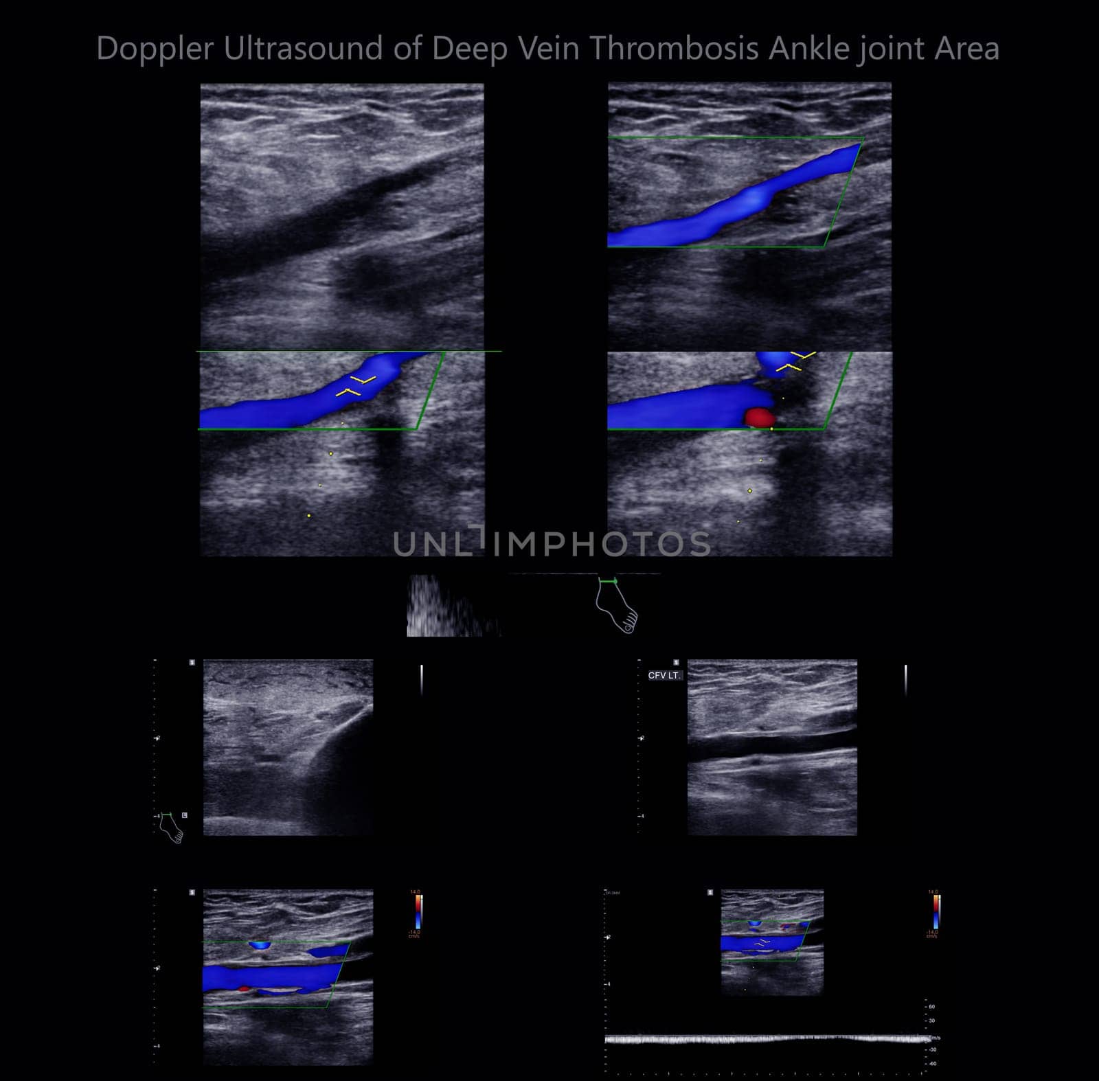 Color Doppler ultrasound determination in deep vein thrombosis patients for finding  deep vein thrombosis of lower extremity. by samunella