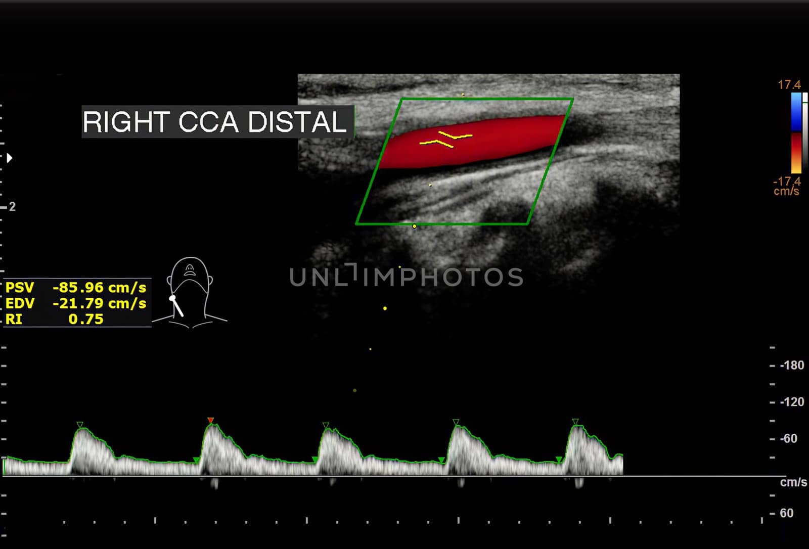 A carotid artery Doppler ultrasound is a diagnostic test used to check the arteries in the neck for diagnosis  any blockage in the veins by a blood clot or “thrombus” formation.