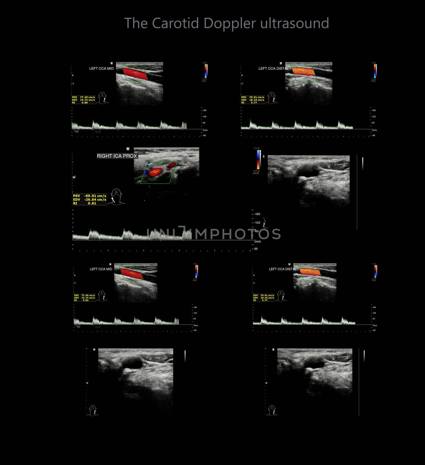 A carotid artery Doppler ultrasound is a diagnostic test used to check the arteries in the neck for diagnosis  any blockage in the veins by a blood clot or “thrombus” formation.