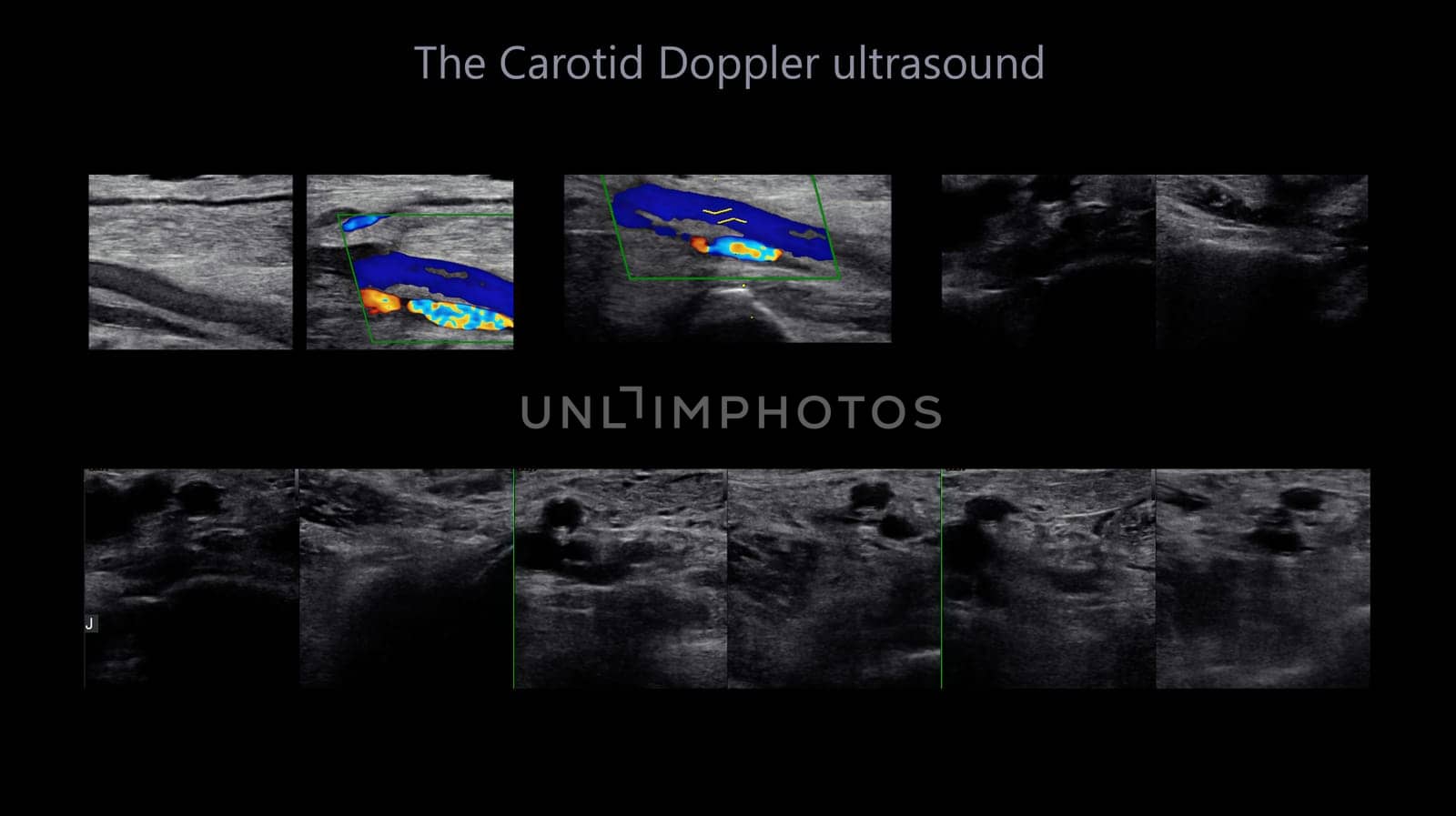 A carotid artery Doppler ultrasound is a diagnostic test used to check the arteries in the neck for diagnosis  any blockage in the veins by a blood clot or “thrombus” formation.